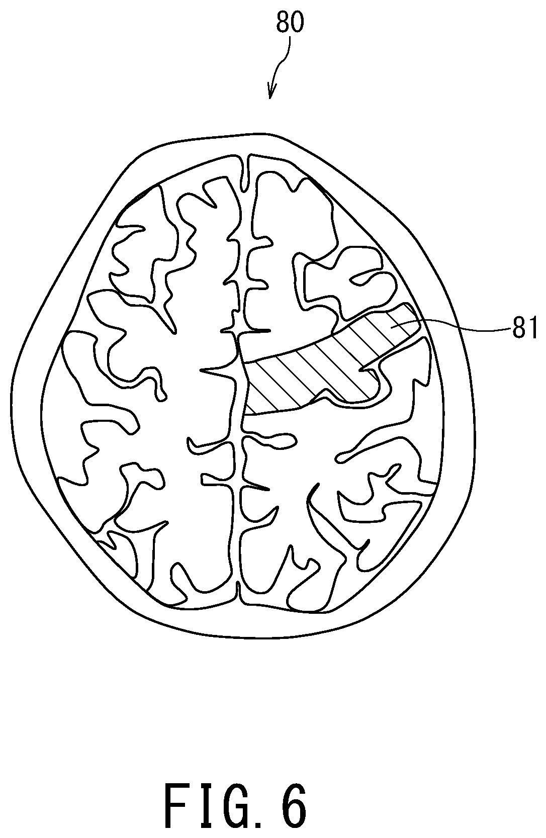 Patent US12496029 Figure 5 – Medical image processing apparatus, X-ray diagnostic apparatus, and storage medium