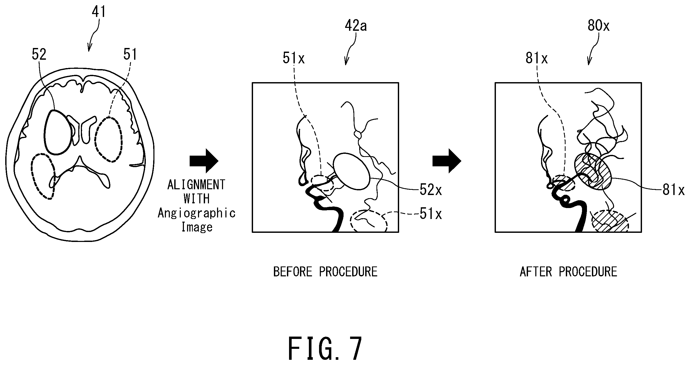 Patent US12496029 Figure 6 – Medical image processing apparatus, X-ray diagnostic apparatus, and storage medium