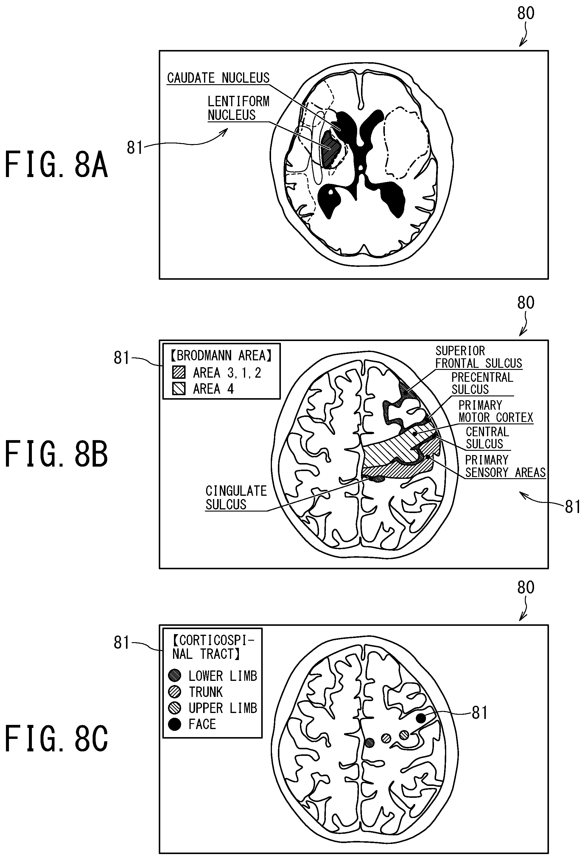 Patent US12496029 Figure 7 – Medical image processing apparatus, X-ray diagnostic apparatus, and storage medium
