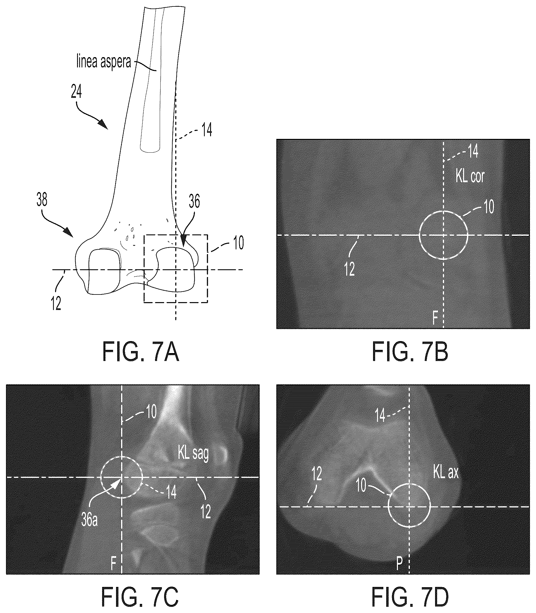 Patent US12496033 Figure 6 – For measuring the axial (transverse), coronal (frontal) and sagittal (bisection) alignment of a lower limb