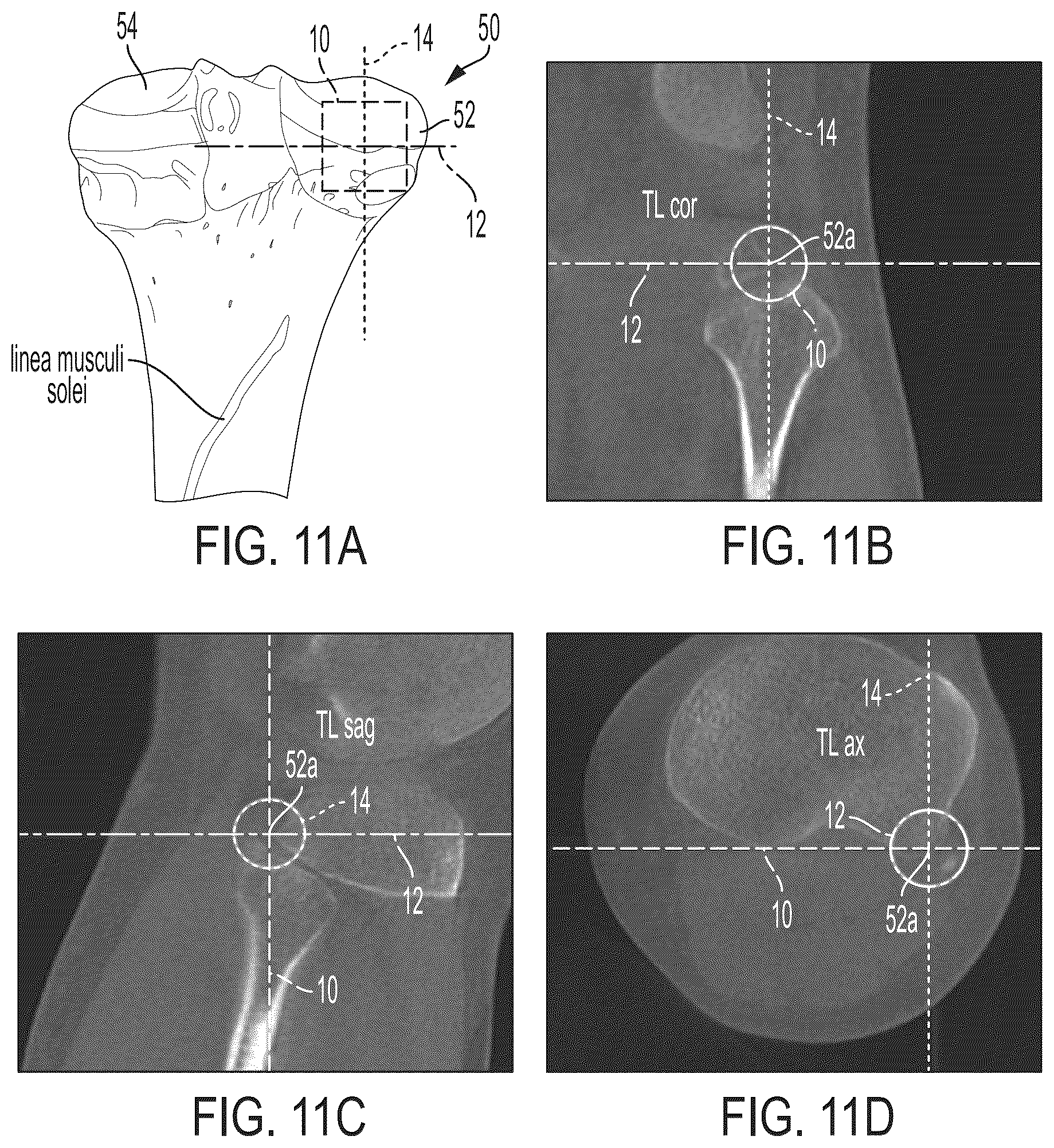 Patent US12496033 Figure 10 – For measuring the axial (transverse), coronal (frontal) and sagittal (bisection) alignment of a lower limb