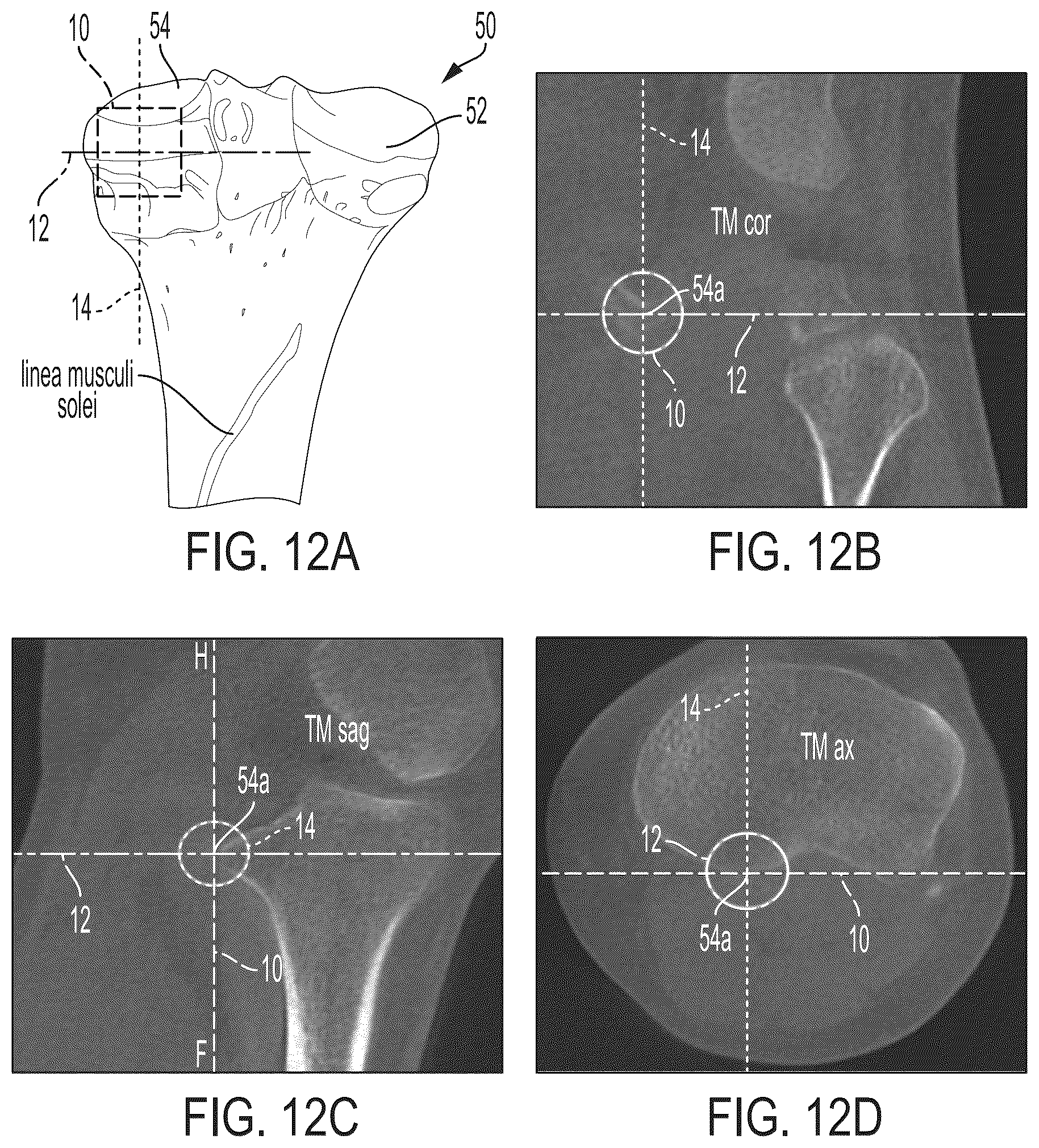 Patent US12496033 Figure 11 – For measuring the axial (transverse), coronal (frontal) and sagittal (bisection) alignment of a lower limb