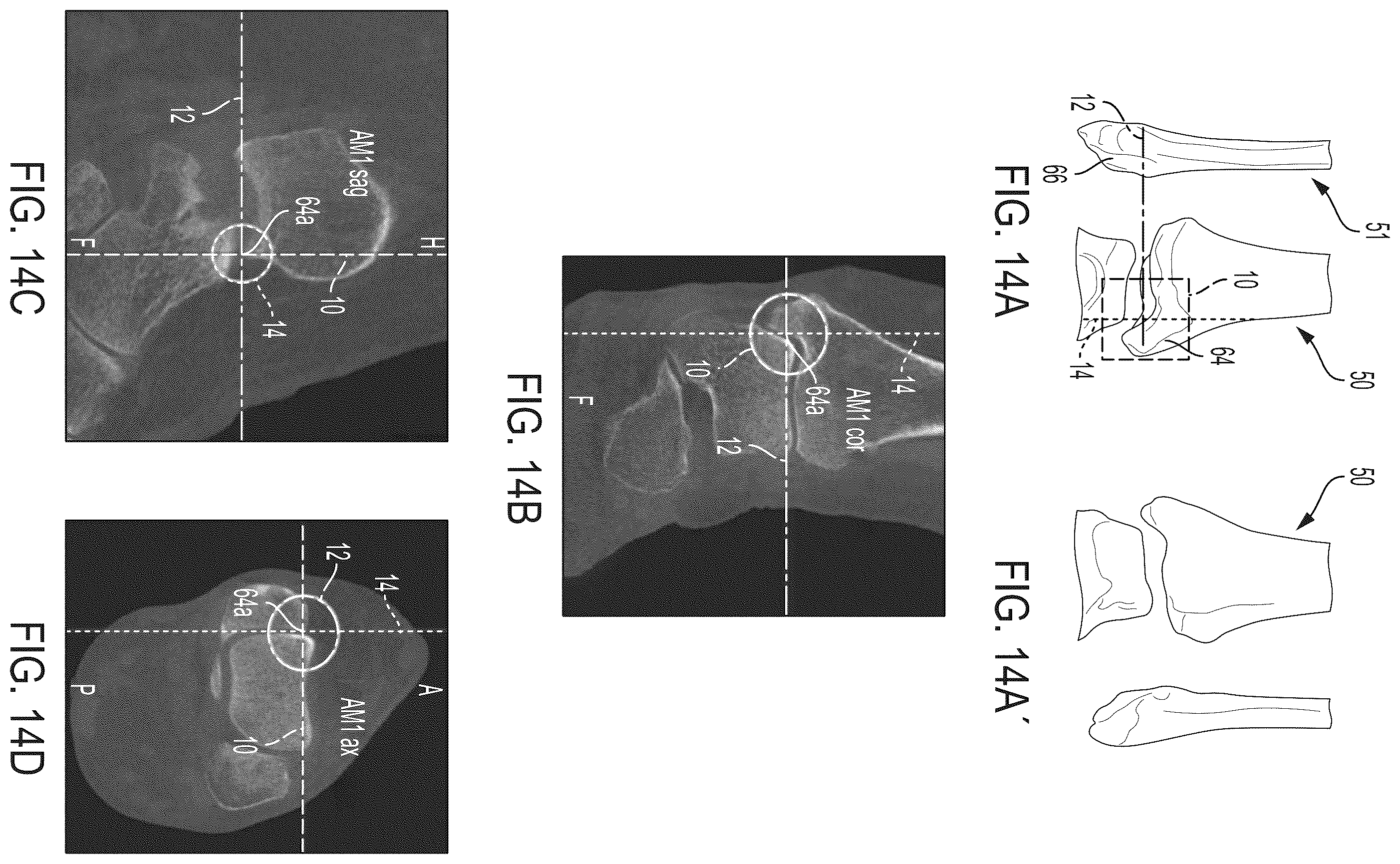 Patent US12496033 Figure 13 – For measuring the axial (transverse), coronal (frontal) and sagittal (bisection) alignment of a lower limb
