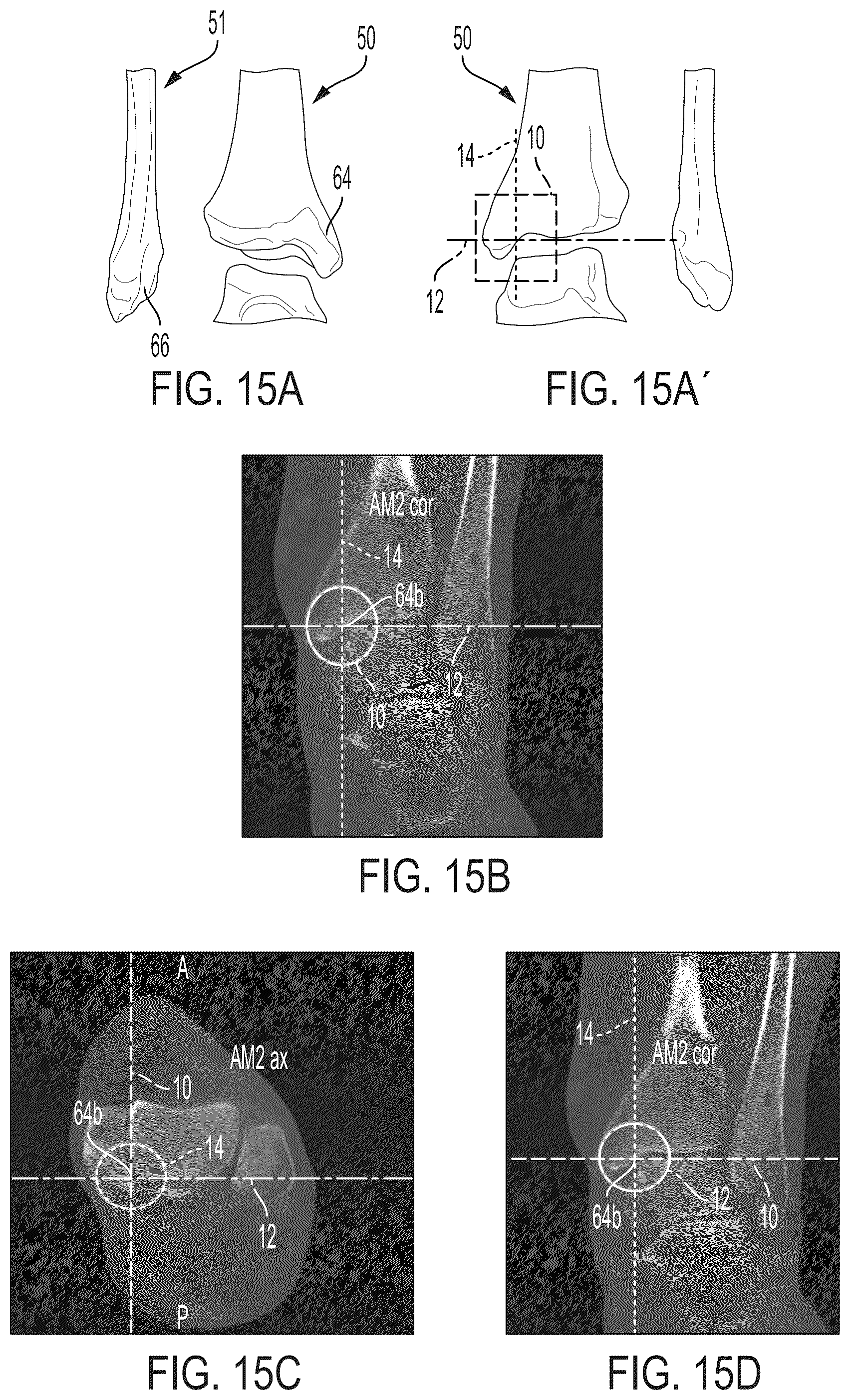 Patent US12496033 Figure 14 – For measuring the axial (transverse), coronal (frontal) and sagittal (bisection) alignment of a lower limb