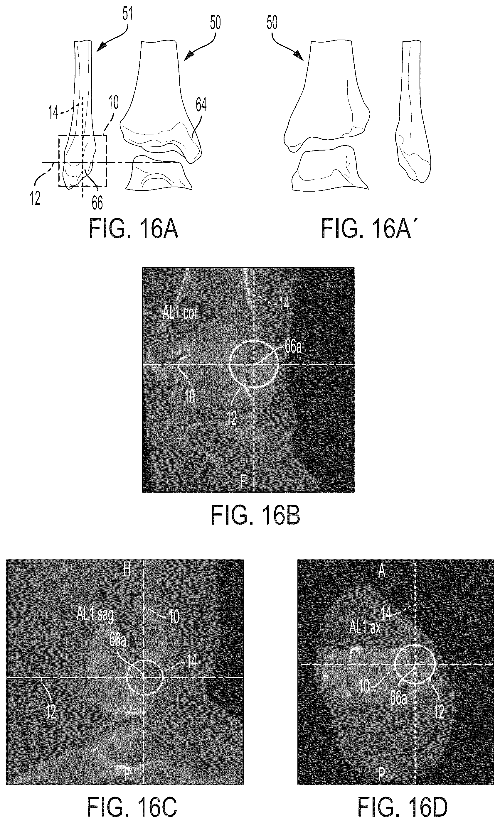 Patent US12496033 Figure 15 – For measuring the axial (transverse), coronal (frontal) and sagittal (bisection) alignment of a lower limb