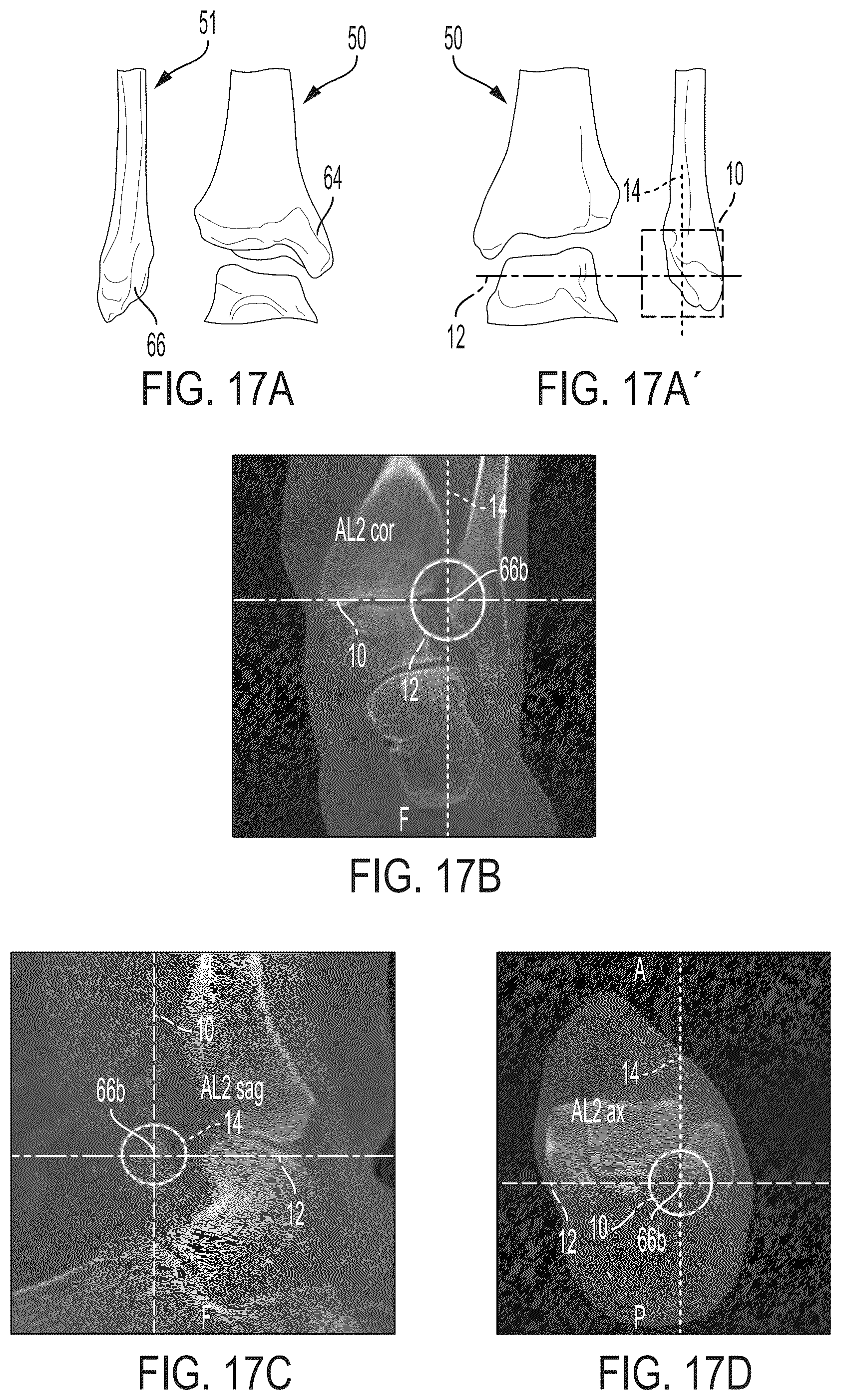 Patent US12496033 Figure 16 – For measuring the axial (transverse), coronal (frontal) and sagittal (bisection) alignment of a lower limb