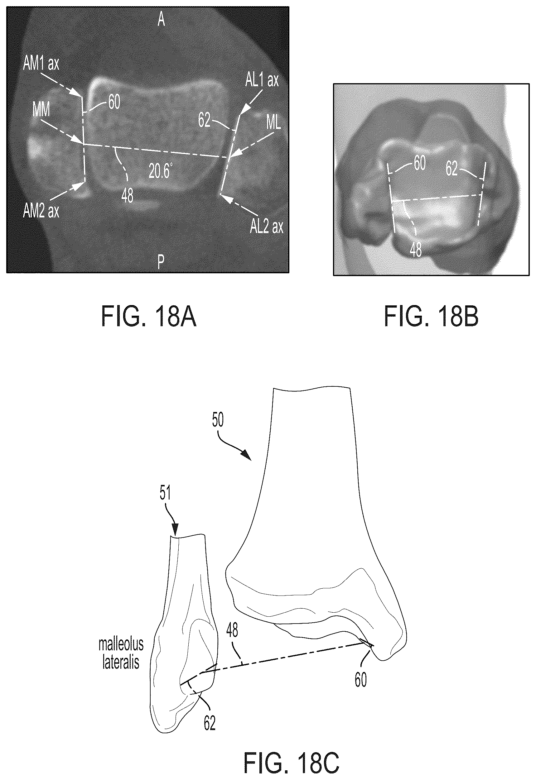 Patent US12496033 Figure 17 – For measuring the axial (transverse), coronal (frontal) and sagittal (bisection) alignment of a lower limb