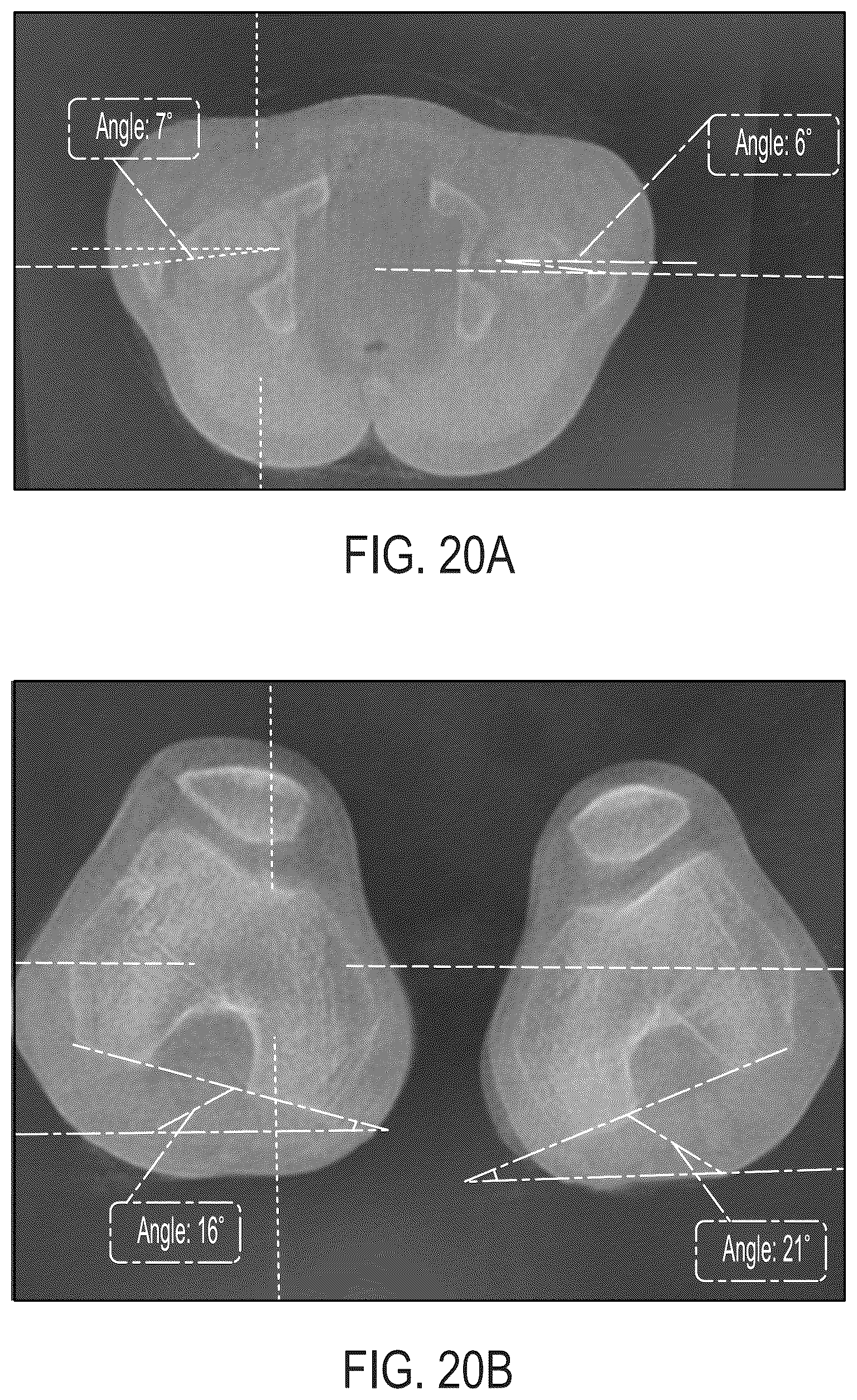 Patent US12496033 Figure 19 – For measuring the axial (transverse), coronal (frontal) and sagittal (bisection) alignment of a lower limb