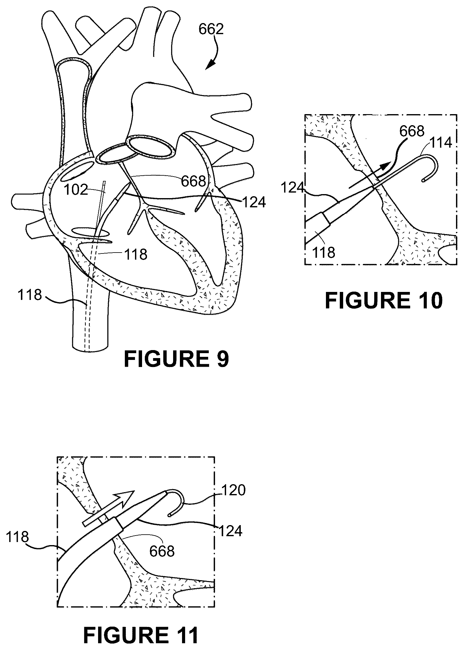 Patent US12496041 Figure 9 – Medical device assembly and related methods