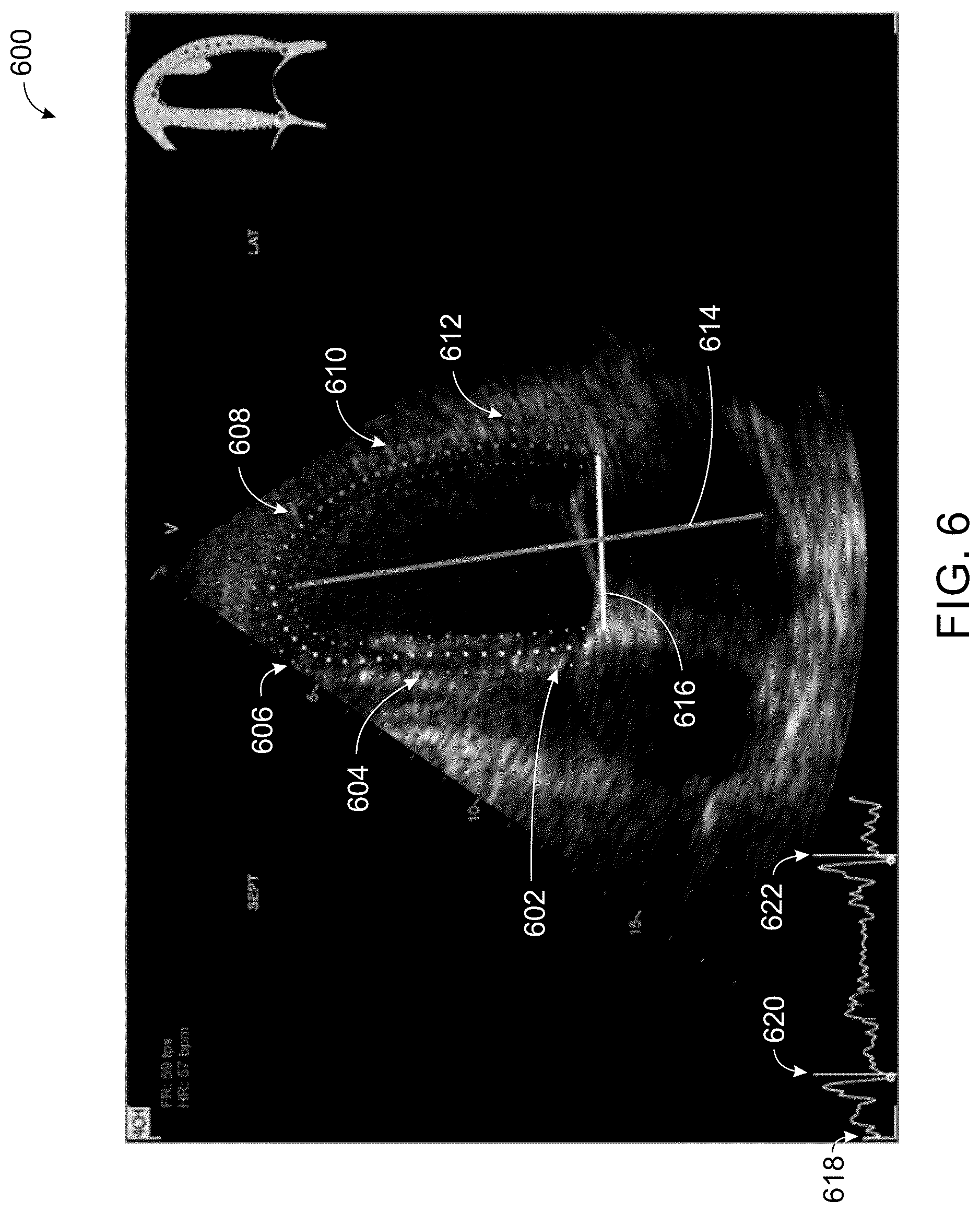 Patent US12496044 Figure 6 – System and method for real-time correction of strain traces in patients with conduction delays
