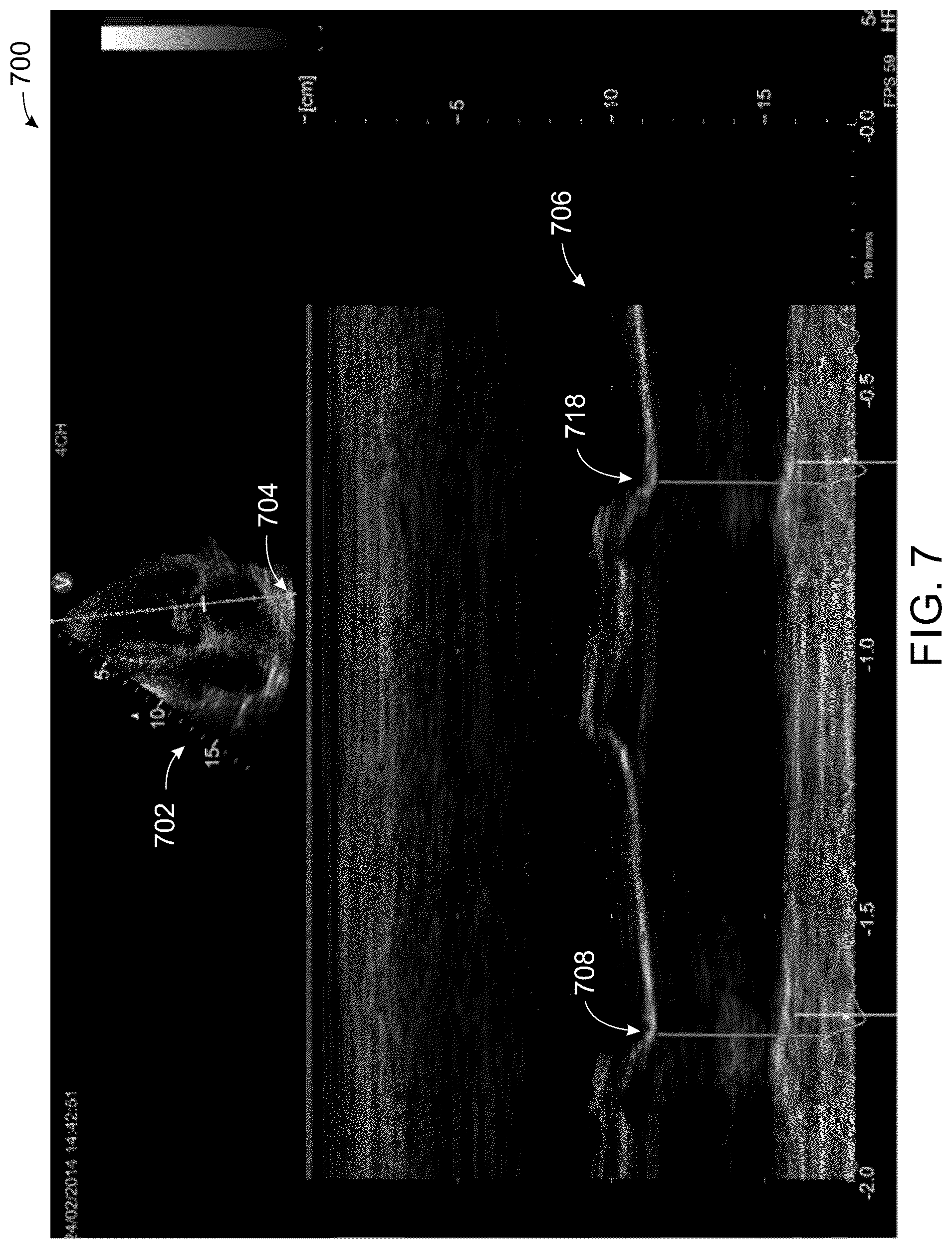 Patent US12496044 Figure 7 – System and method for real-time correction of strain traces in patients with conduction delays