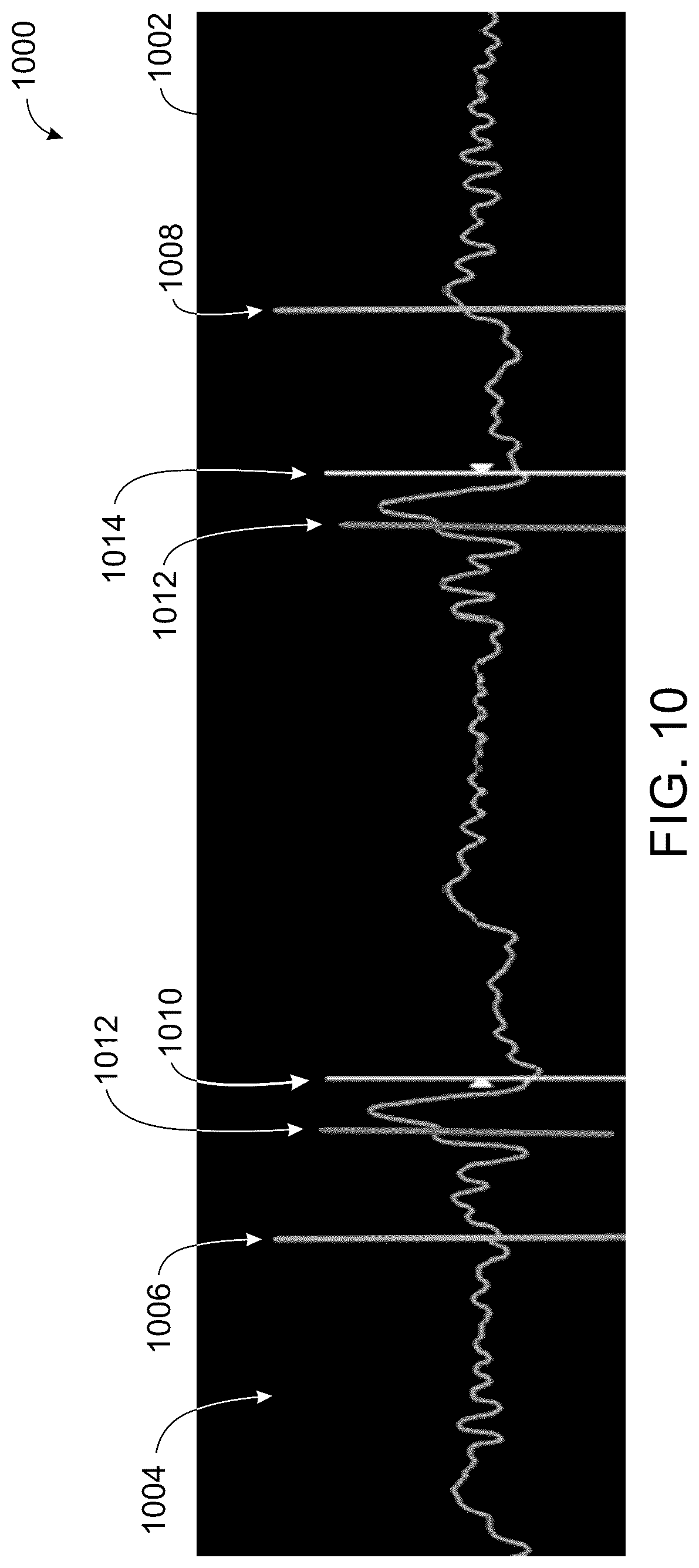 Patent US12496044 Figure 10 – System and method for real-time correction of strain traces in patients with conduction delays