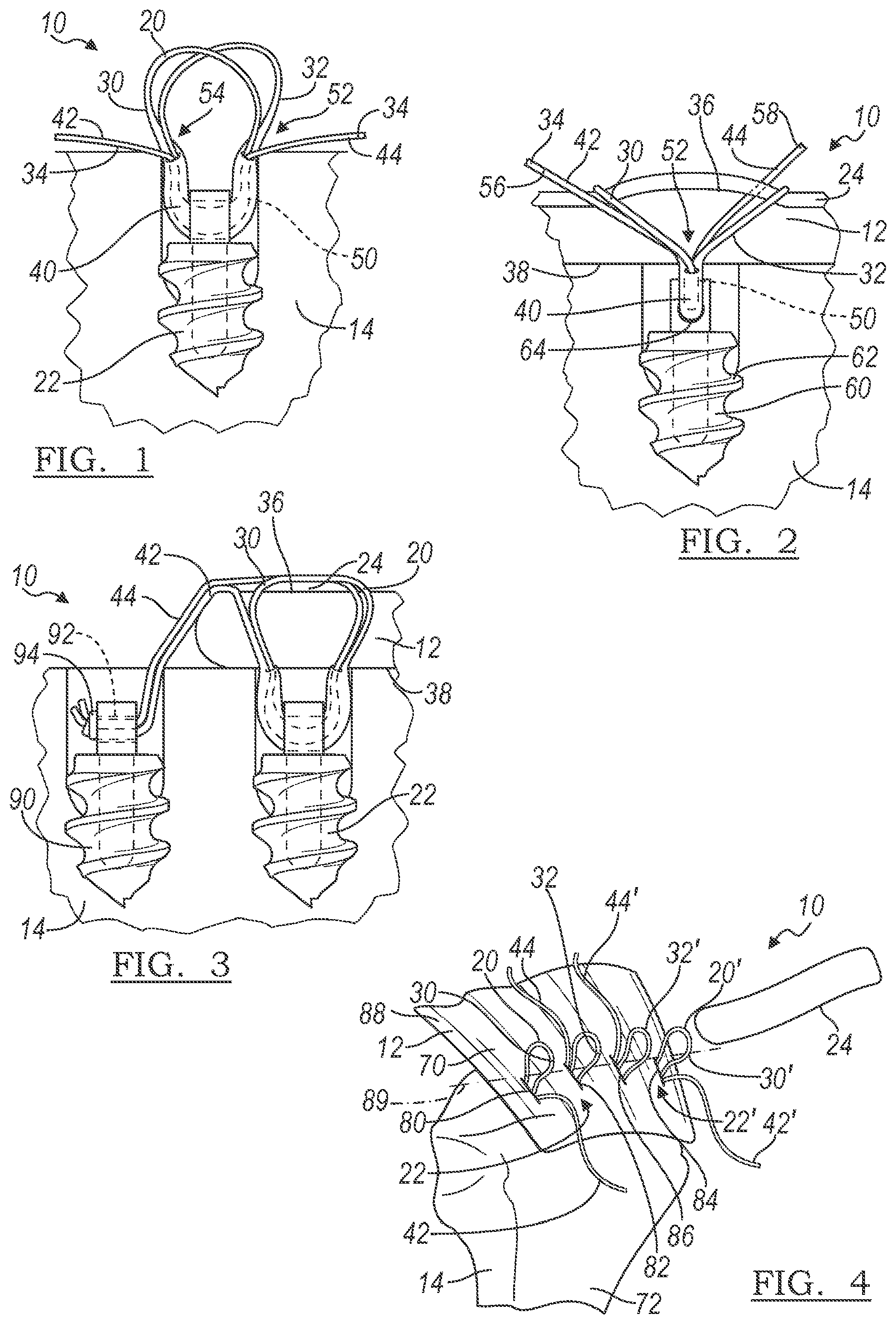 Patent US12496059 Figure 1 – Method and apparatus for soft tissue fixation