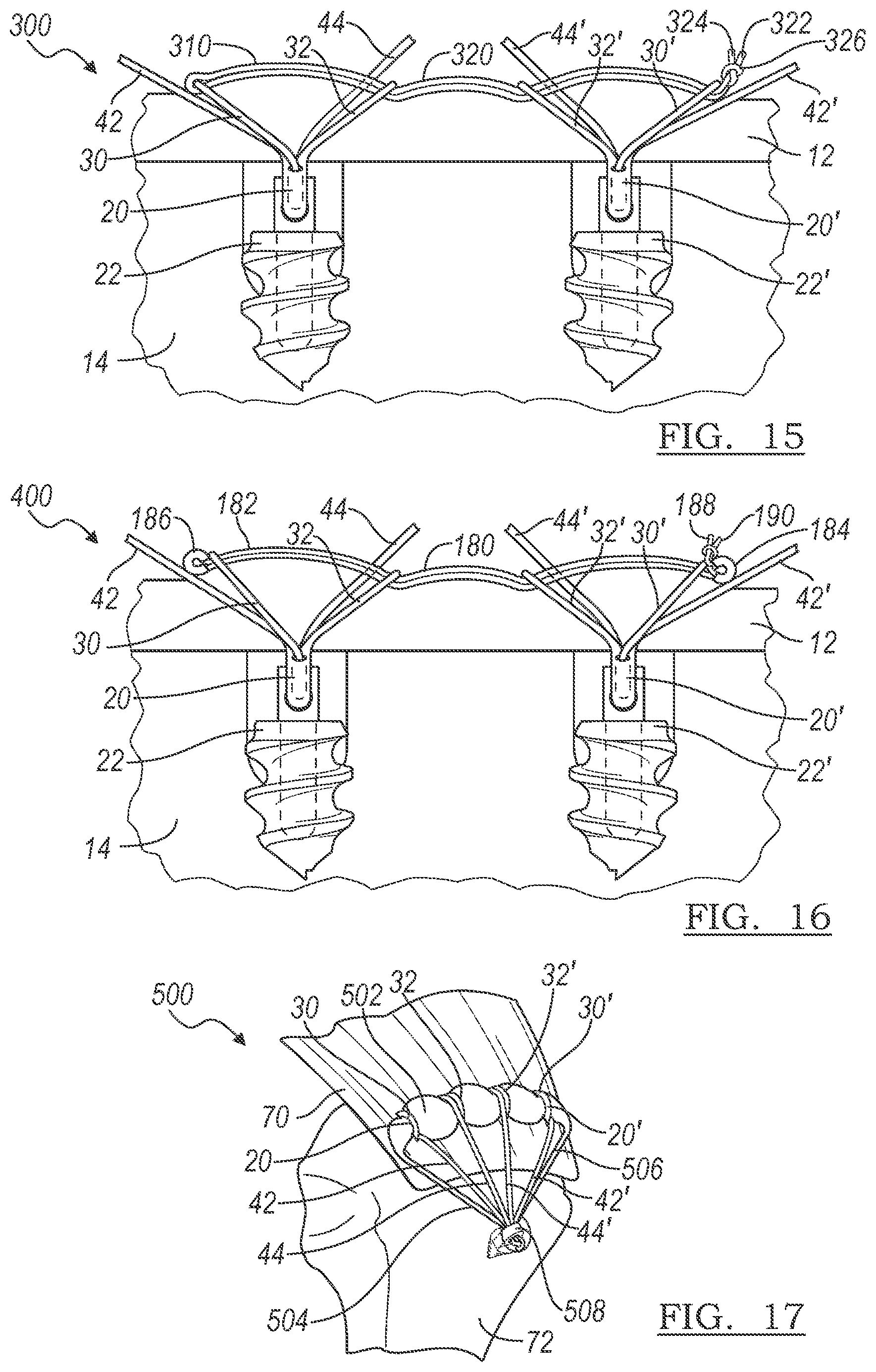 Patent US12496059 Figure 4 – Method and apparatus for soft tissue fixation