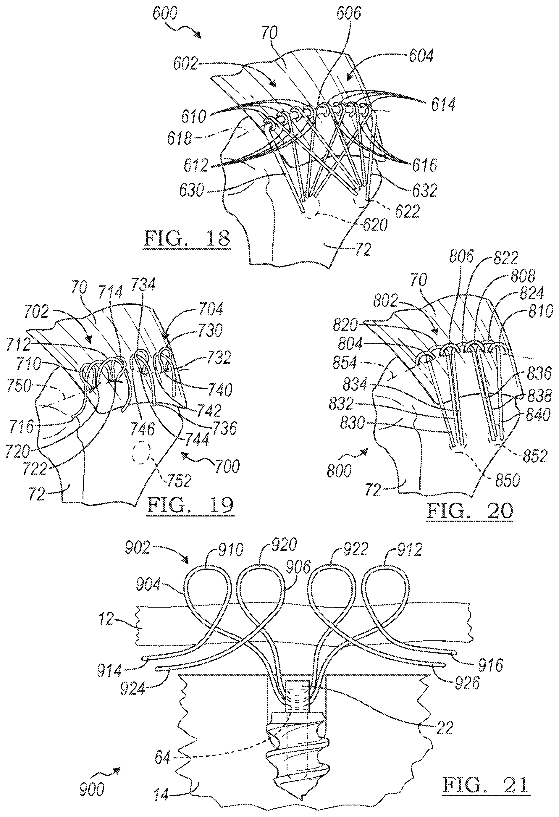 Patent US12496059 Figure 5 – Method and apparatus for soft tissue fixation