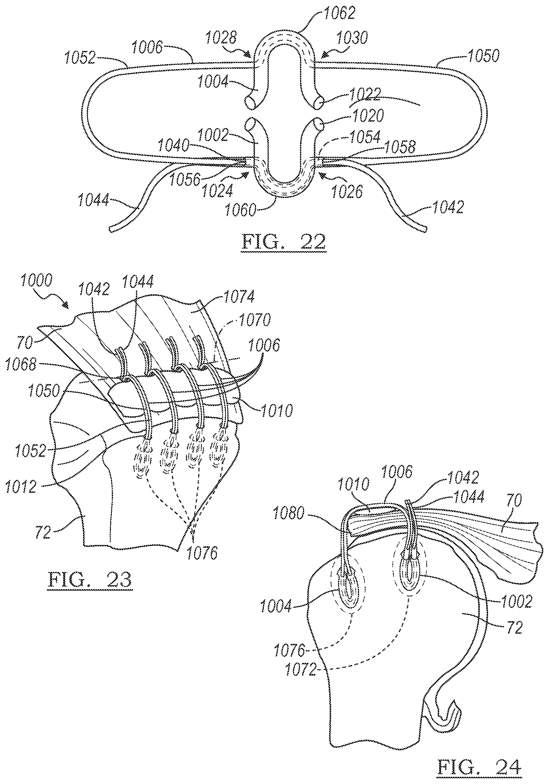 Patent US12496059 Figure 6 – Method and apparatus for soft tissue fixation
