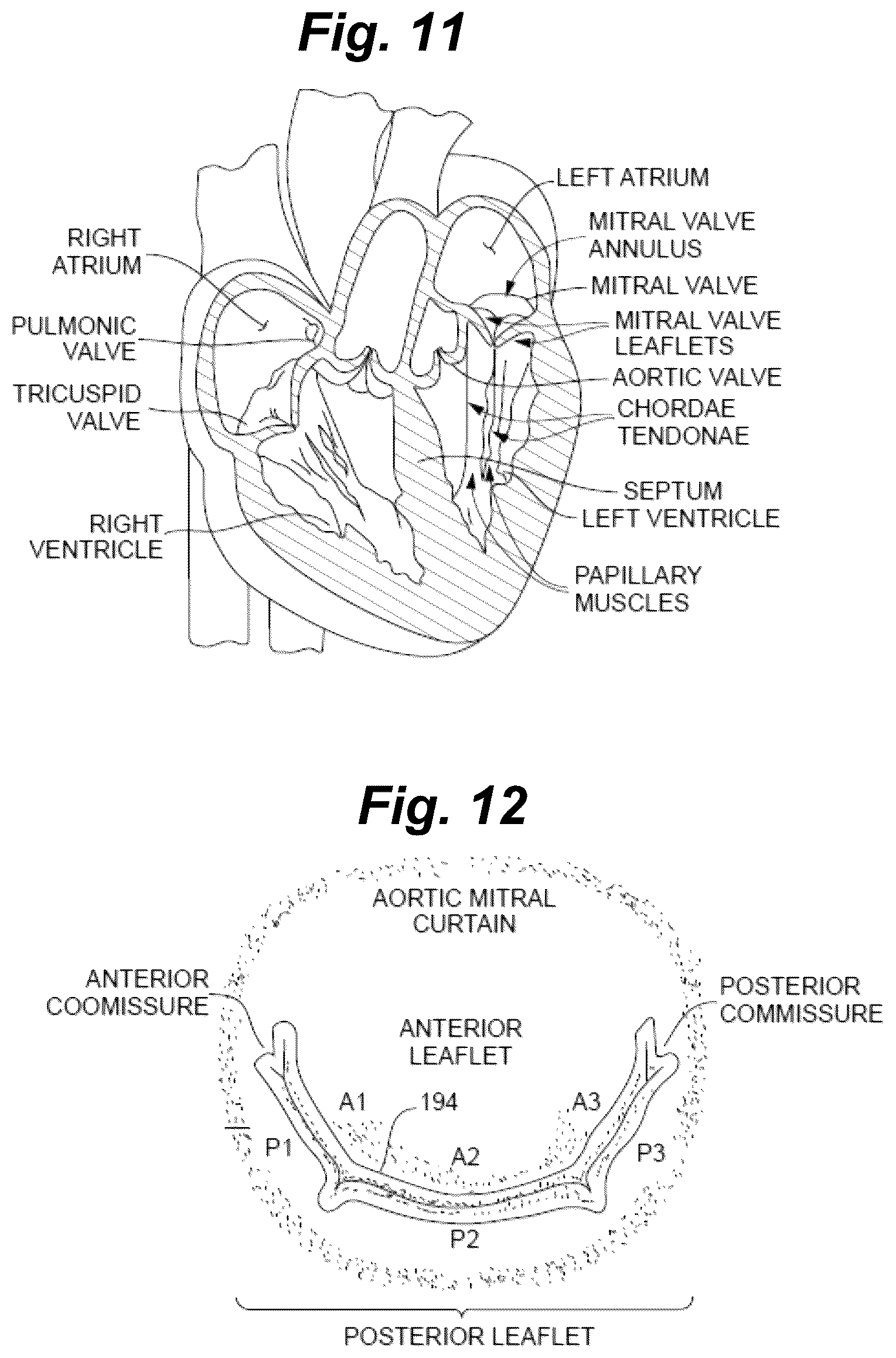 Patent US12496061 Figure 12 – Minimally invasive heart valve repair in a beating heart