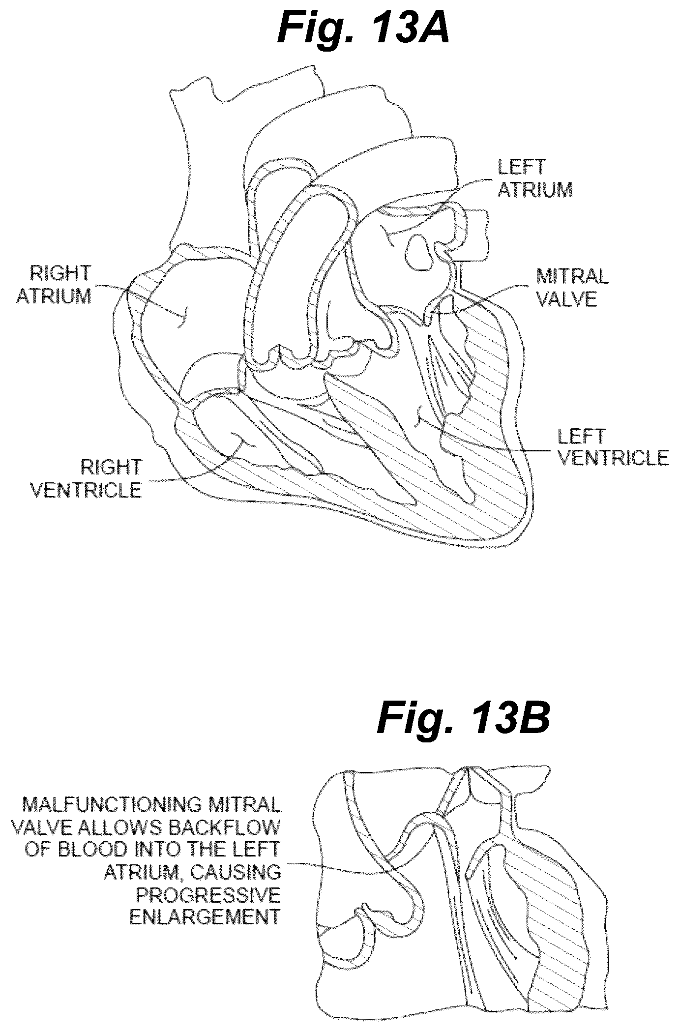 Patent US12496061 Figure 13 – Minimally invasive heart valve repair in a beating heart
