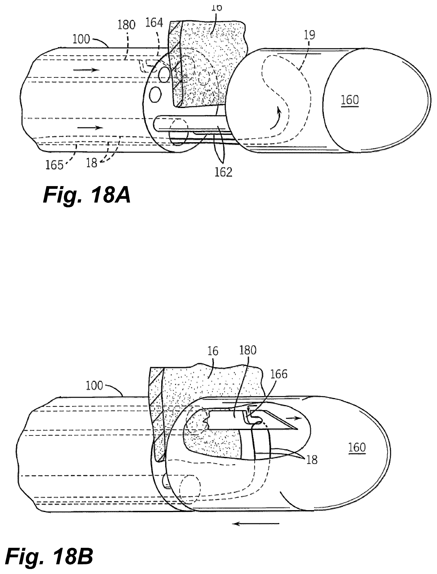 Patent US12496061 Figure 16 – Minimally invasive heart valve repair in a beating heart