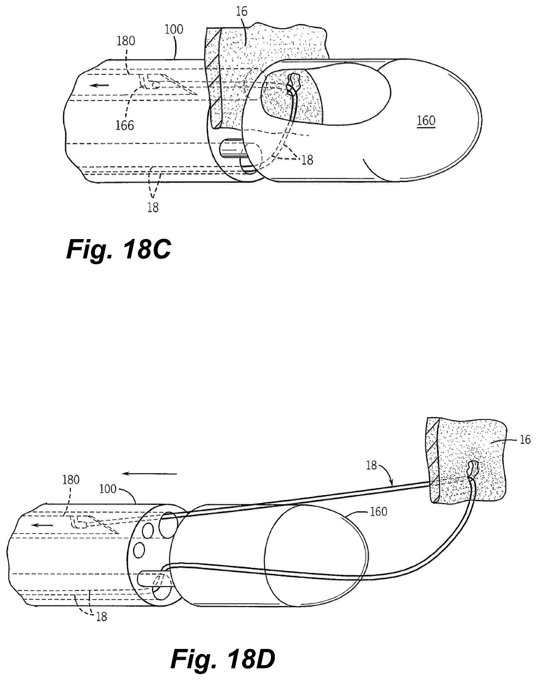 Patent US12496061 Figure 17 – Minimally invasive heart valve repair in a beating heart