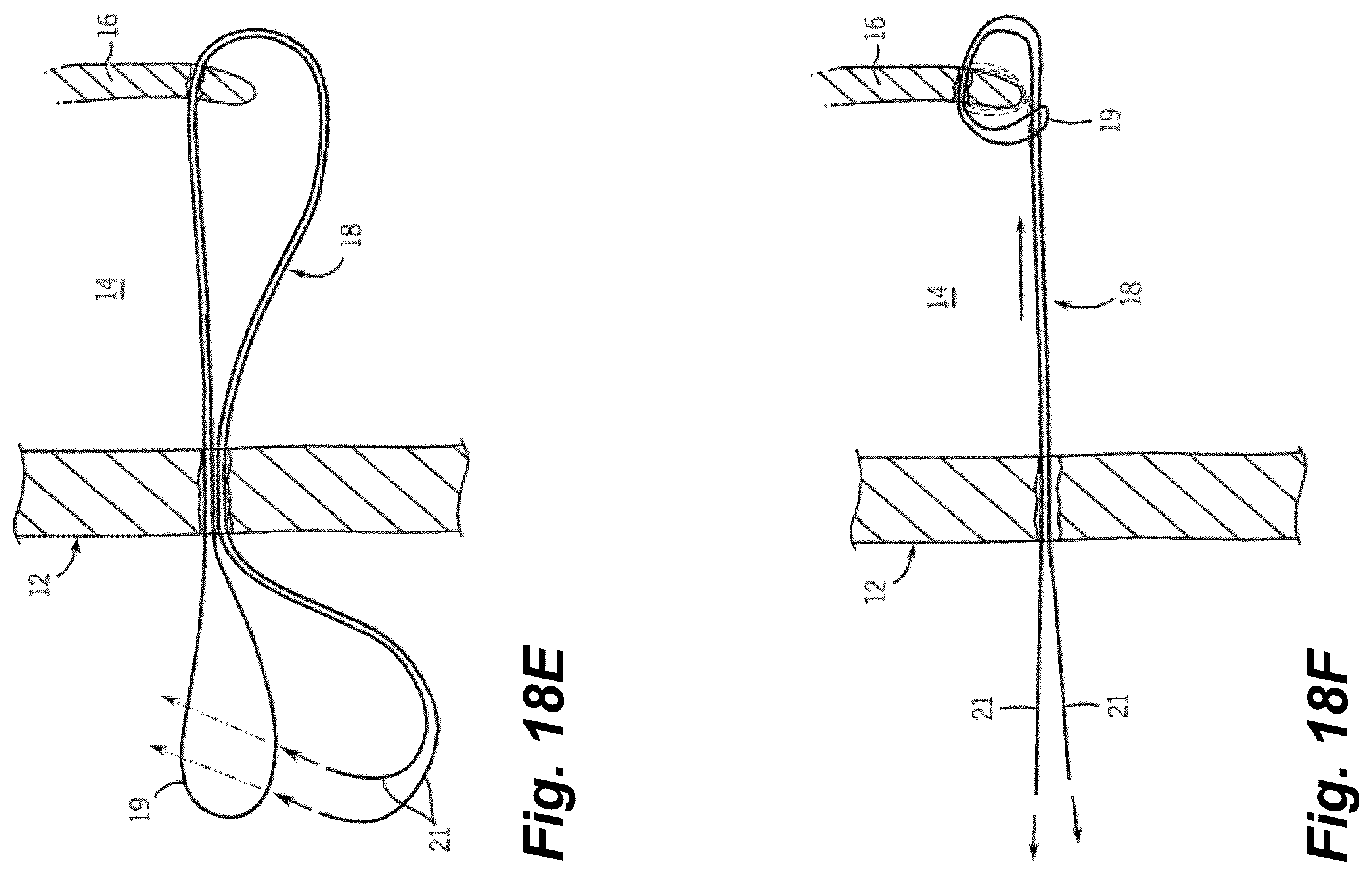 Patent US12496061 Figure 18 – Minimally invasive heart valve repair in a beating heart