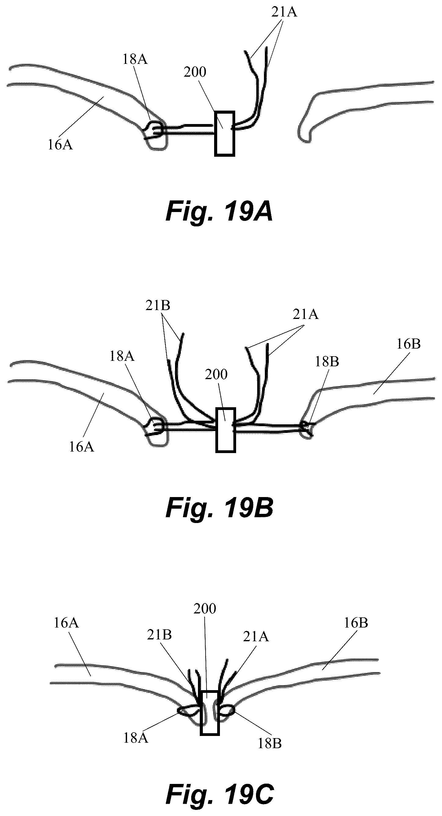 Patent US12496061 Figure 19 – Minimally invasive heart valve repair in a beating heart