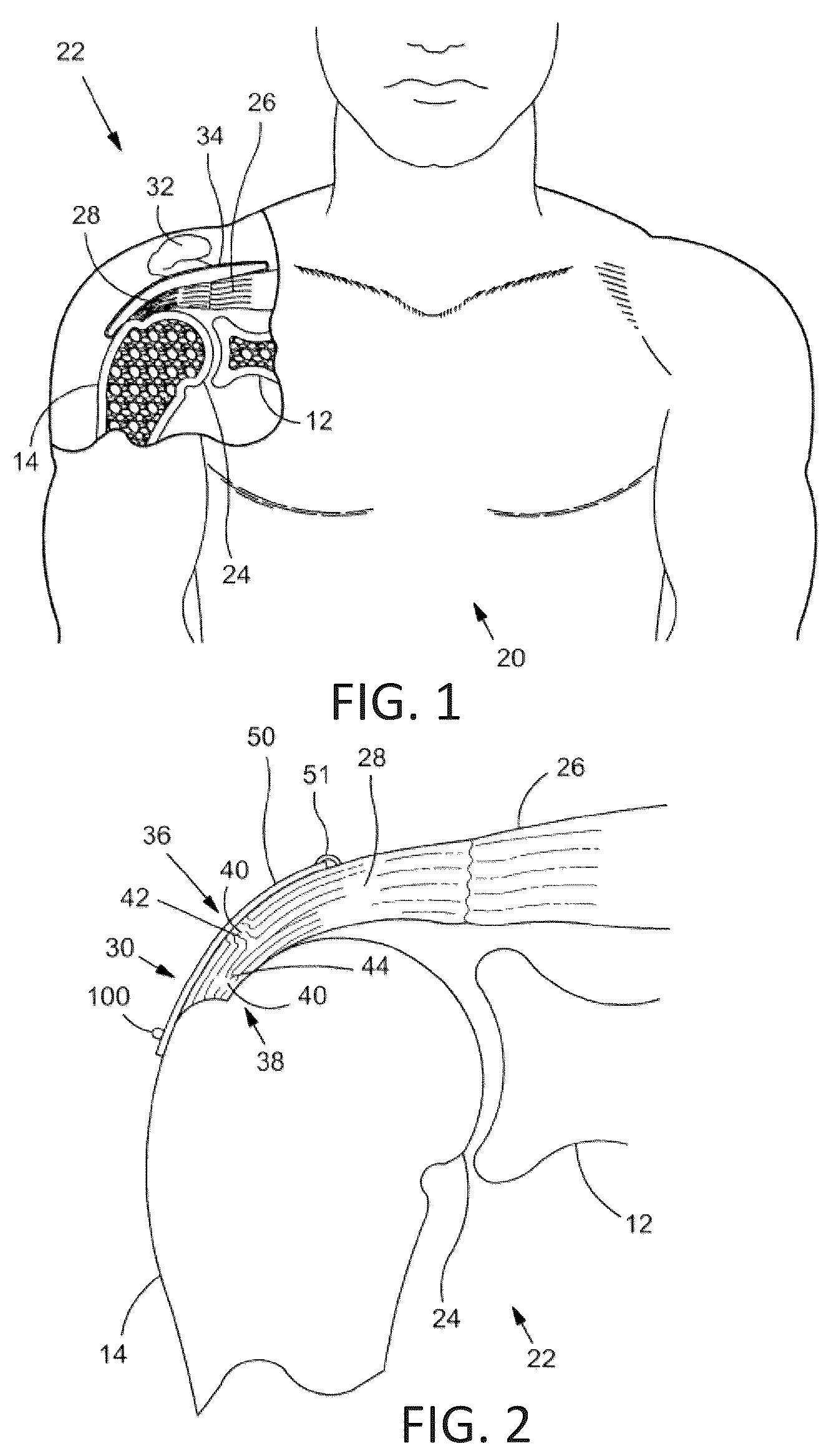 Patent US12496062 Figure 1 – Bone anchor delivery system