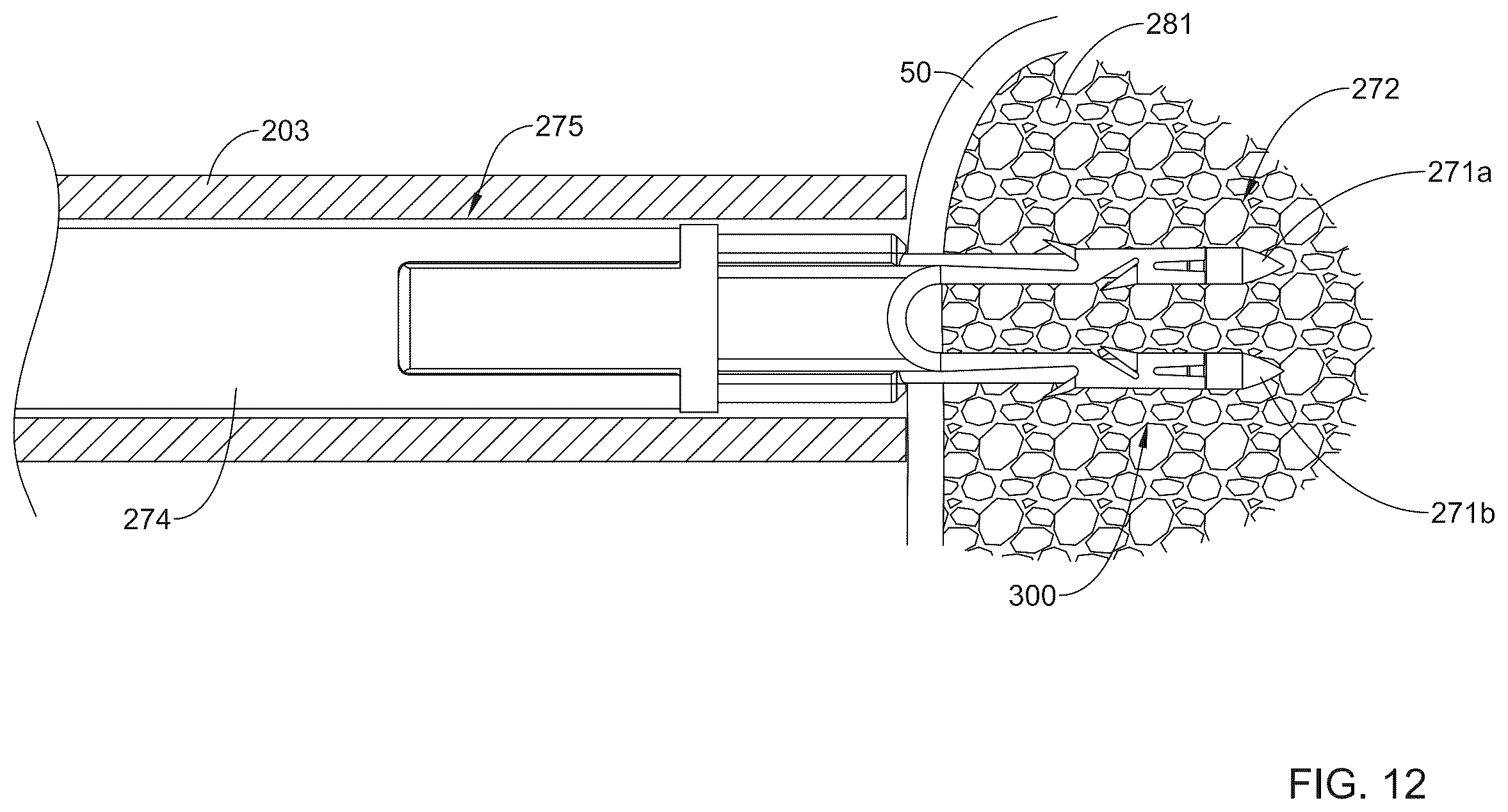 Patent US12496062 Figure 11 – Bone anchor delivery system