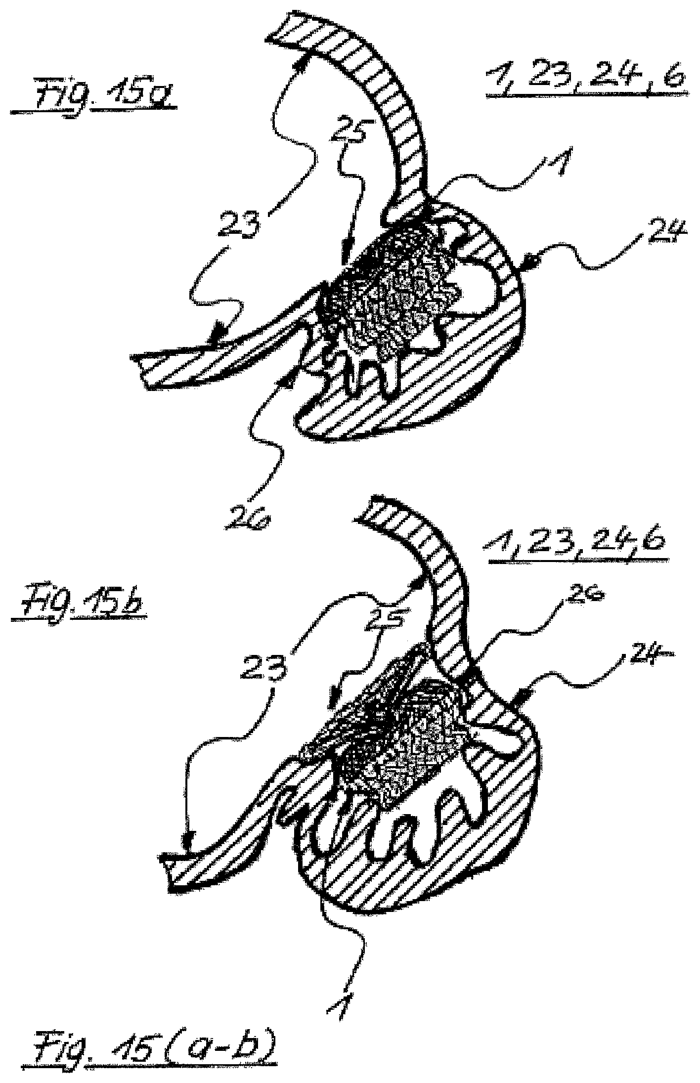 Patent US12496069 Figure 15 – Atrial appendage occluder for closing the left atrial appendage