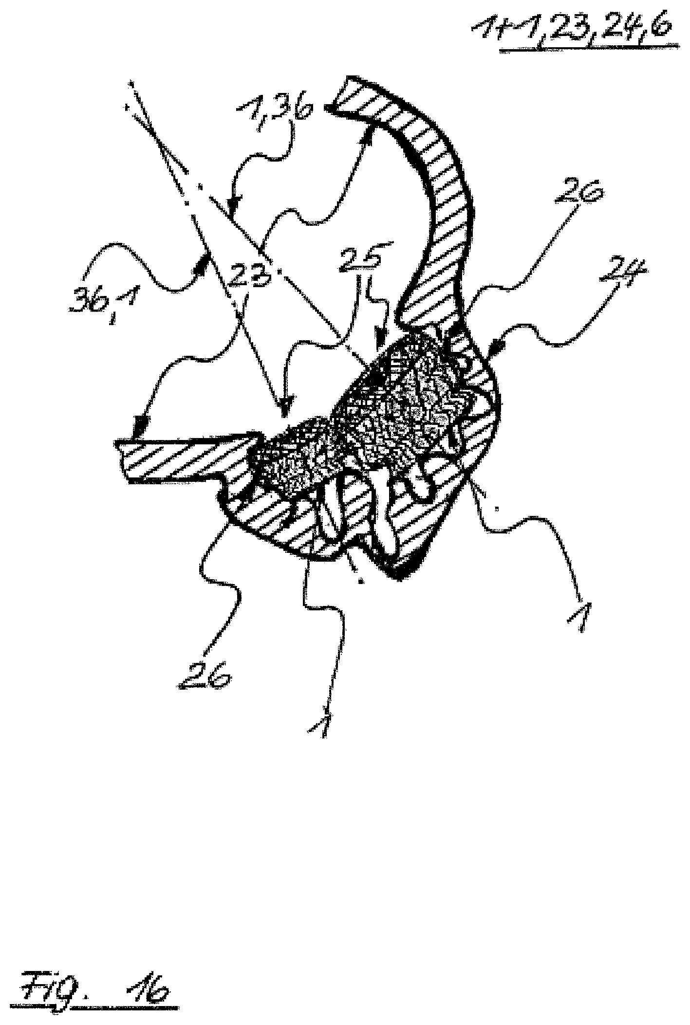 Patent US12496069 Figure 16 – Atrial appendage occluder for closing the left atrial appendage