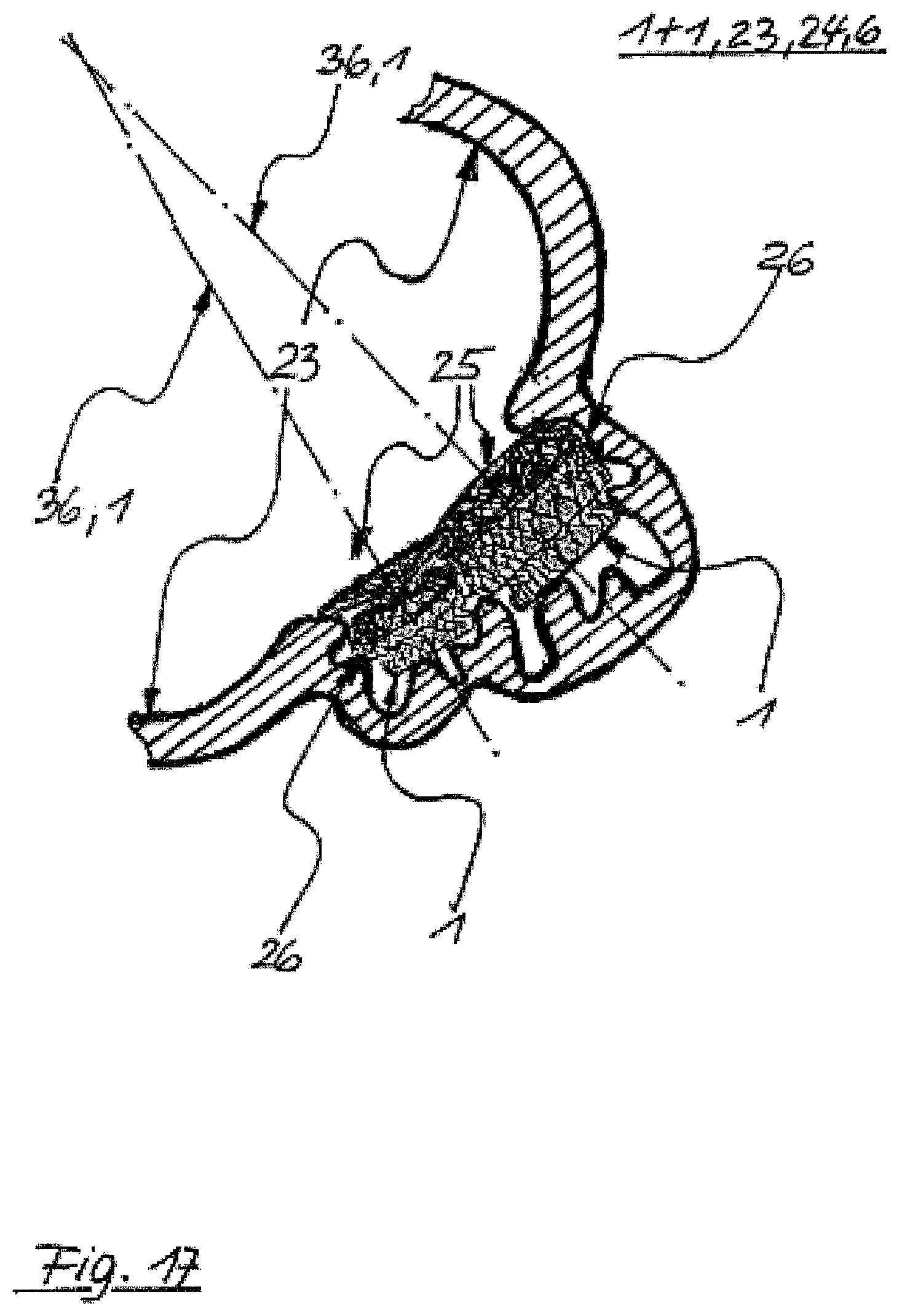 Patent US12496069 Figure 17 – Atrial appendage occluder for closing the left atrial appendage
