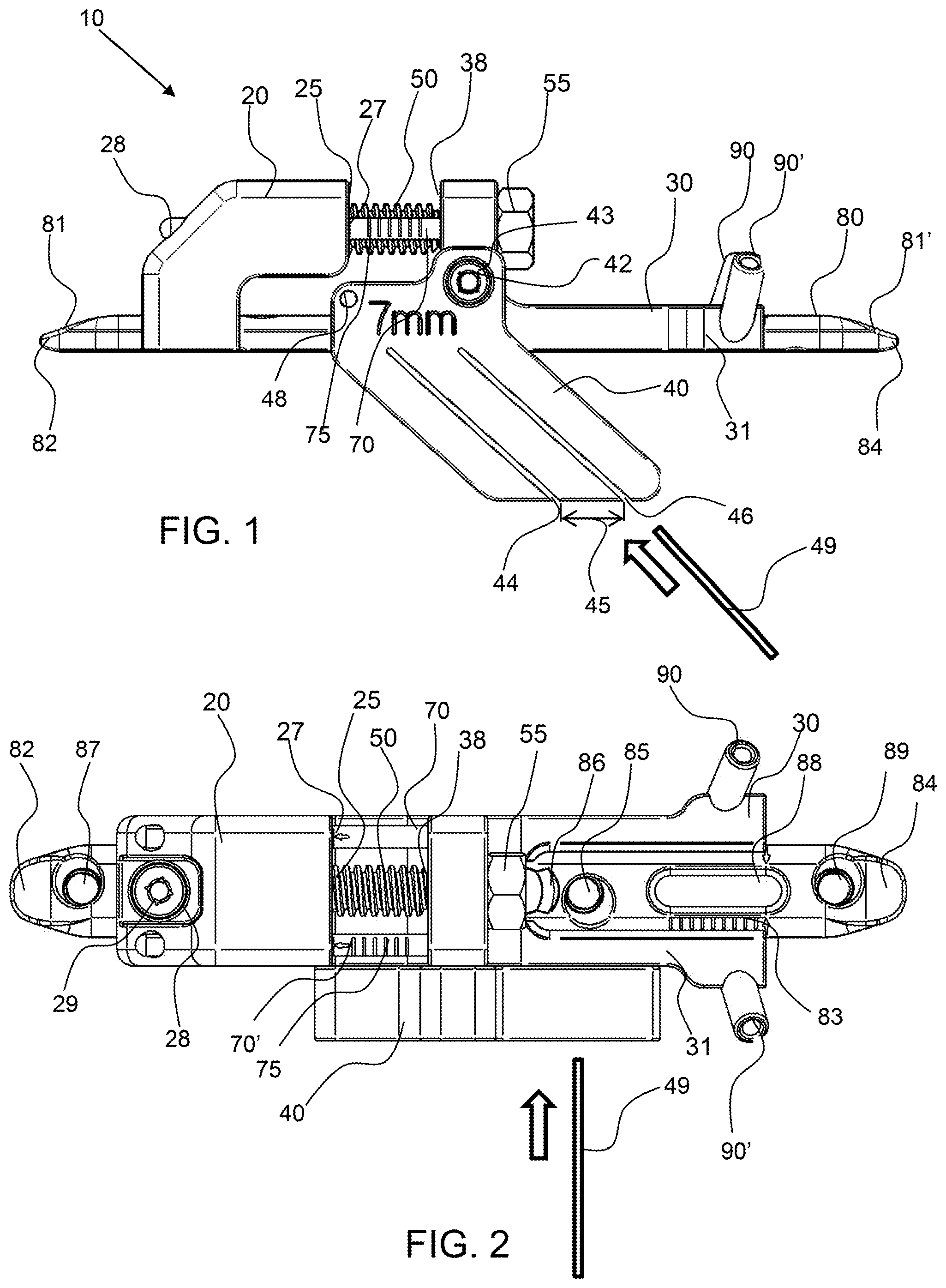 Patent US12496071 Figure 1 – Bone shortening osteotomy apparatus