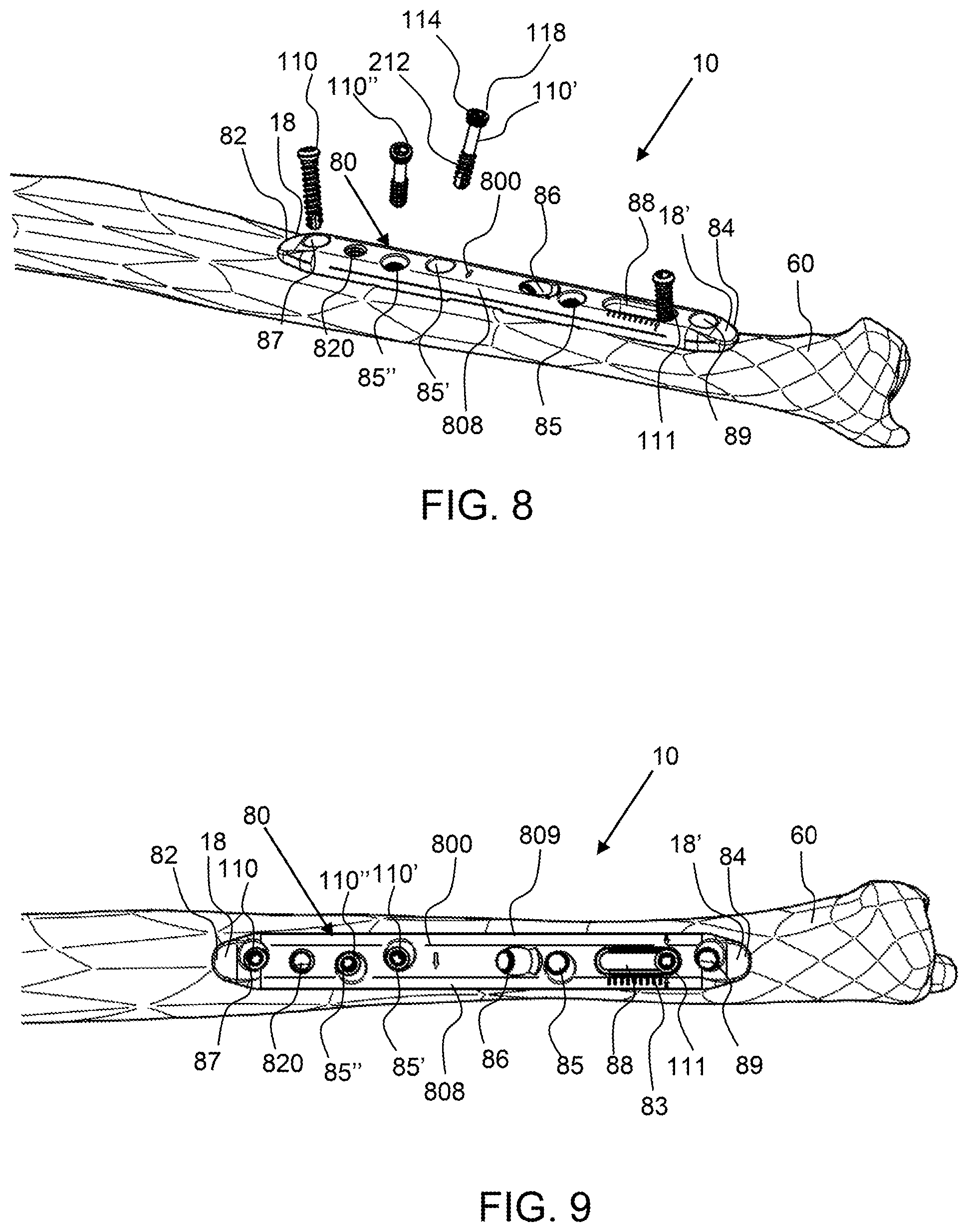 Patent US12496071 Figure 6 – Bone shortening osteotomy apparatus