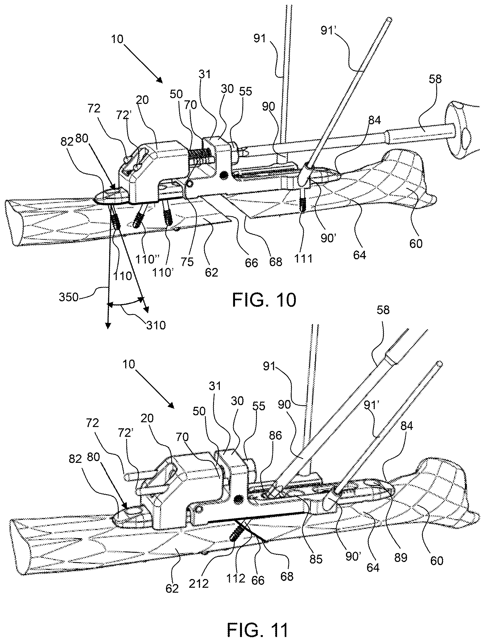 Patent US12496071 Figure 7 – Bone shortening osteotomy apparatus