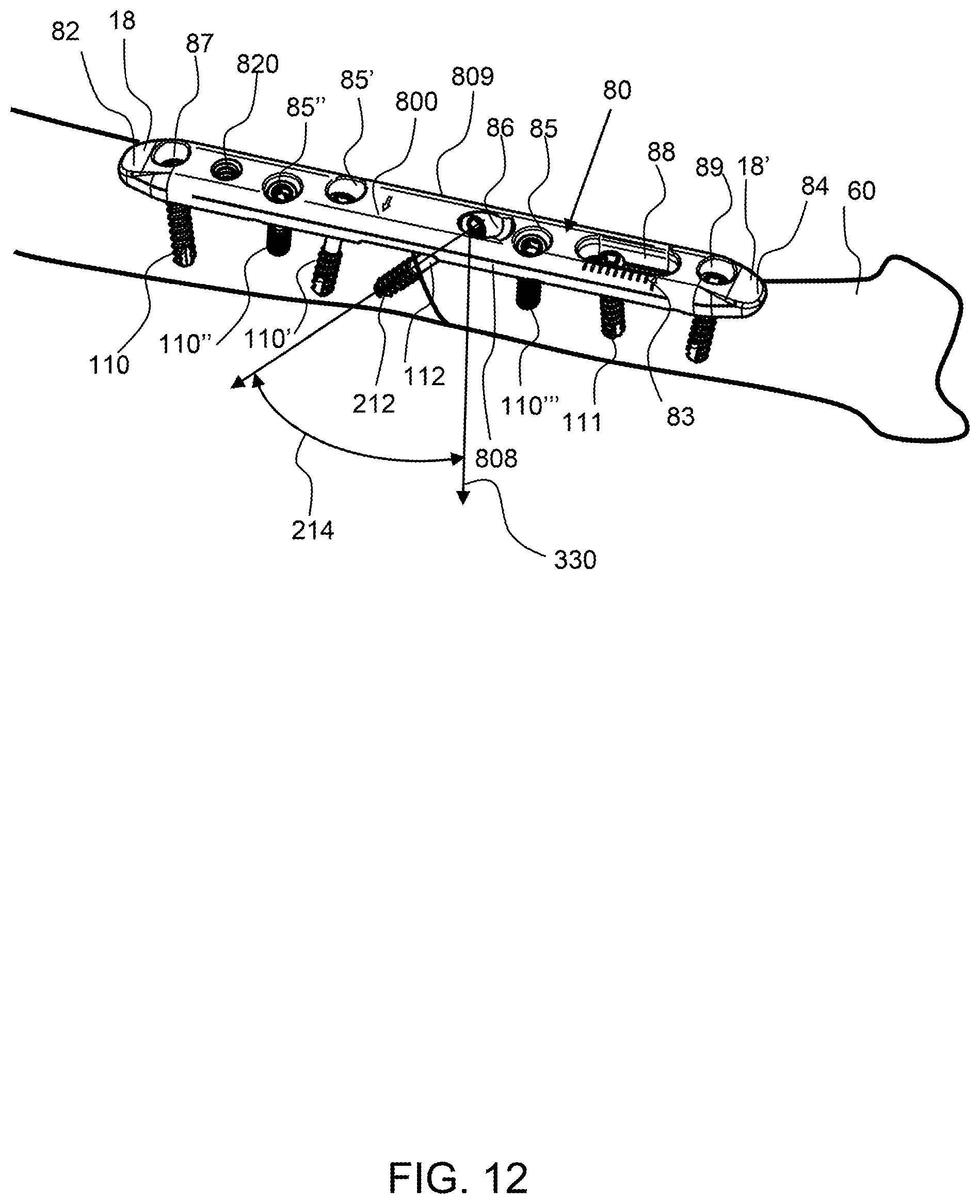 Patent US12496071 Figure 8 – Bone shortening osteotomy apparatus