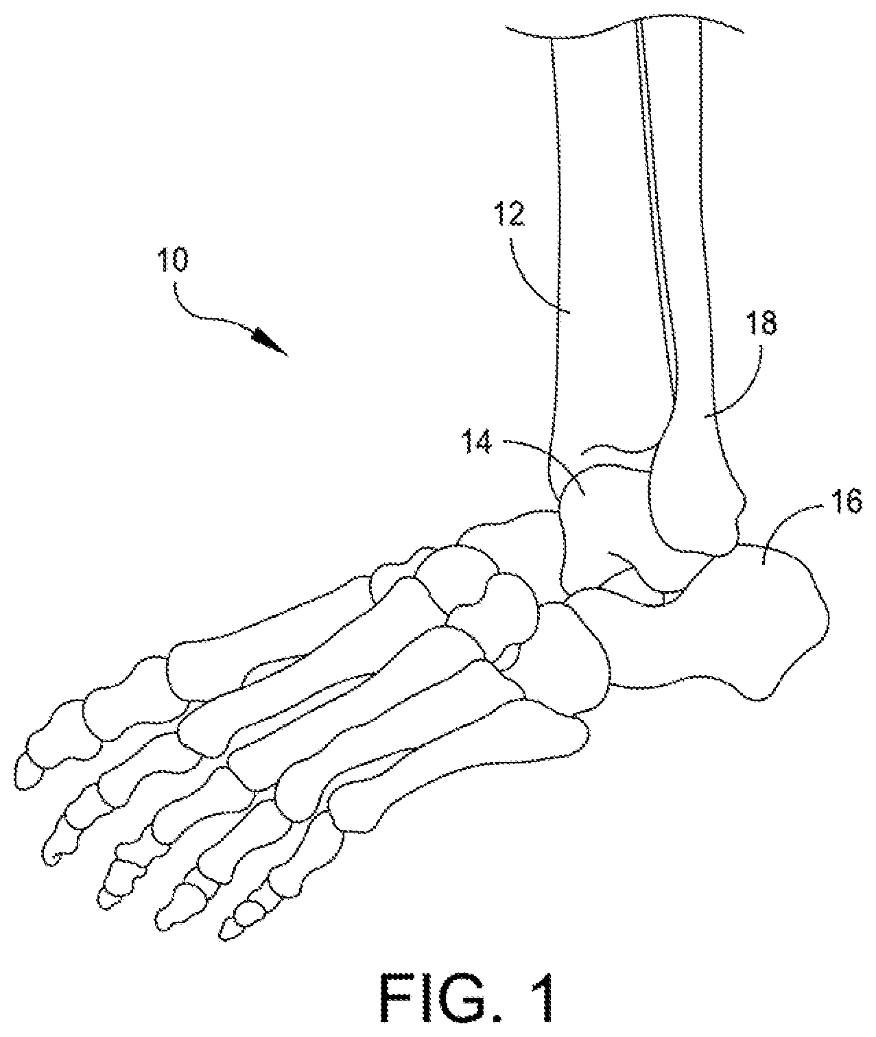 Patent US12496072 Figure 1 – Multi-modal patient-specific surgical guides