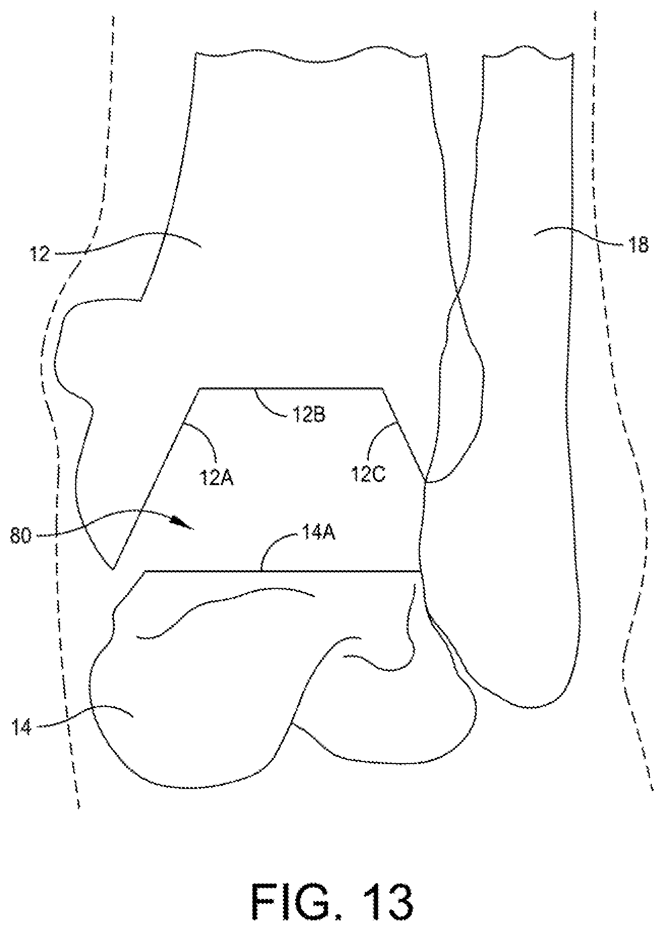 Patent US12496072 Figure 13 – Multi-modal patient-specific surgical guides