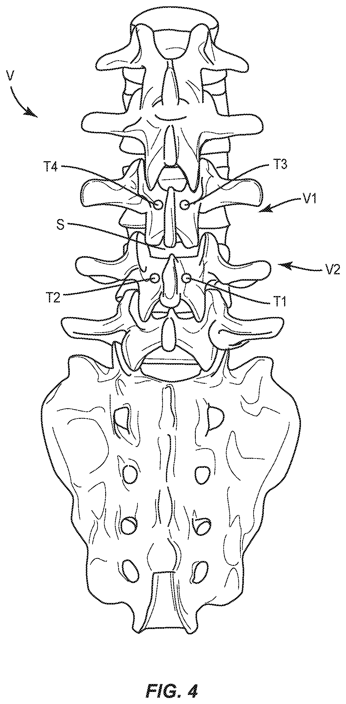 Patent US12496073 Figure 4 – Surgical implant system and methods of use