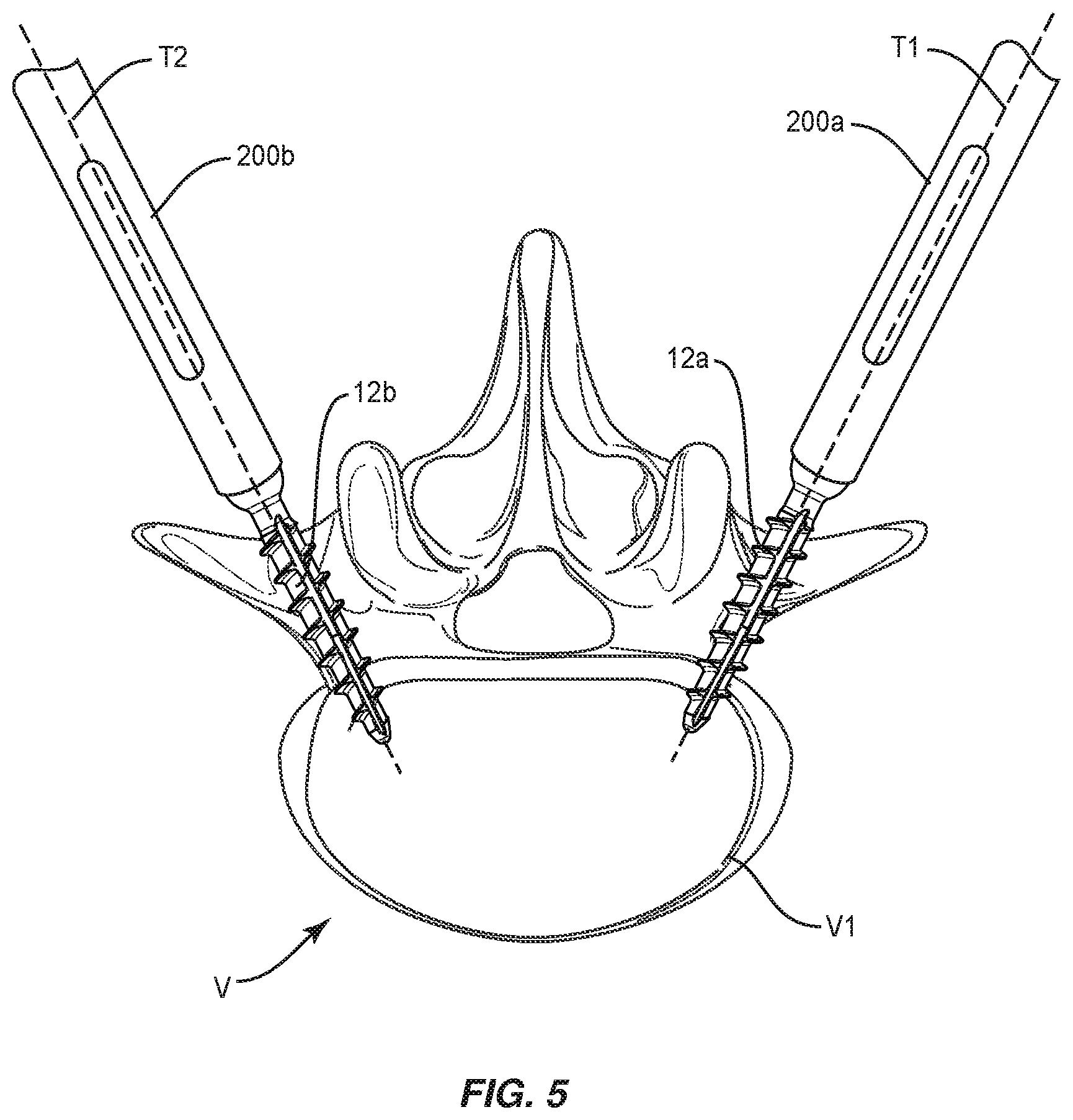 Patent US12496073 Figure 5 – Surgical implant system and methods of use