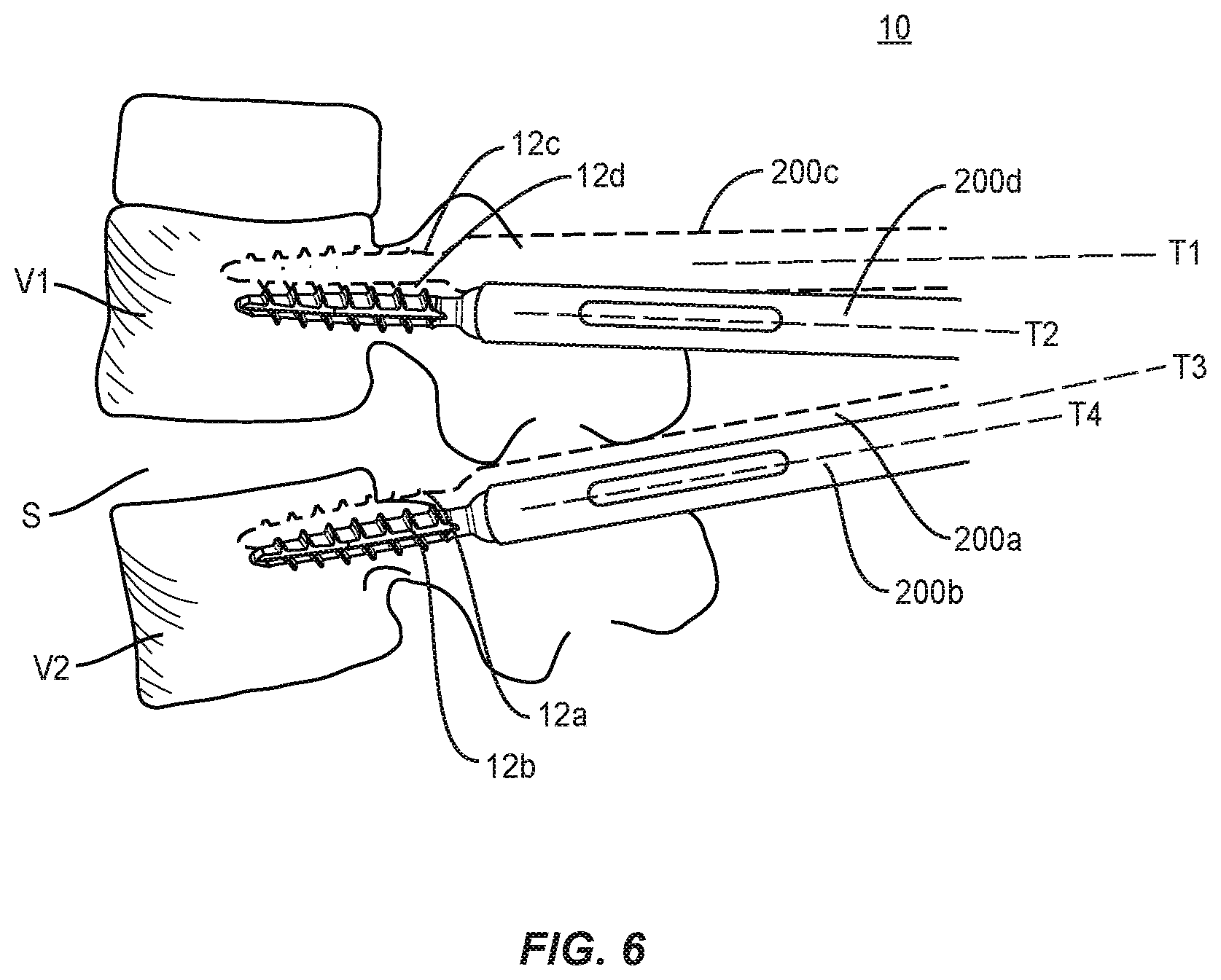 Patent US12496073 Figure 6 – Surgical implant system and methods of use