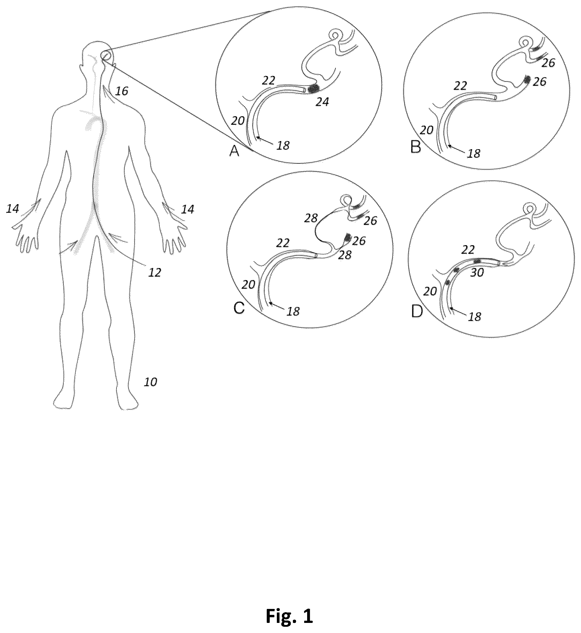 Patent US12496075 Figure 1 – Heart rate synchronous aspiration system and method for treatment of ischemic stroke