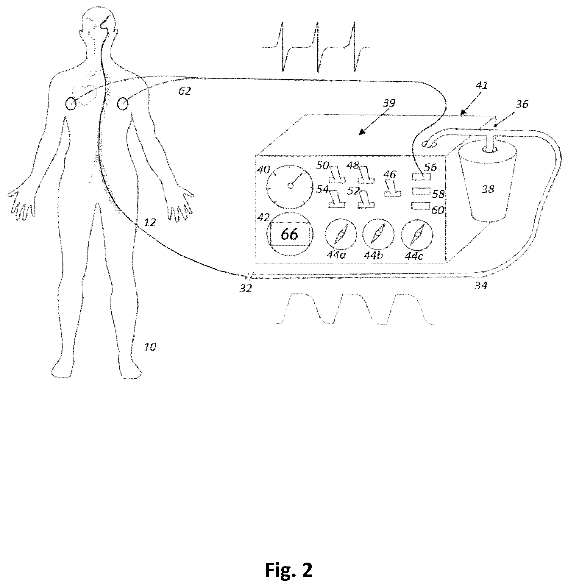 Patent US12496075 Figure 2 – Heart rate synchronous aspiration system and method for treatment of ischemic stroke