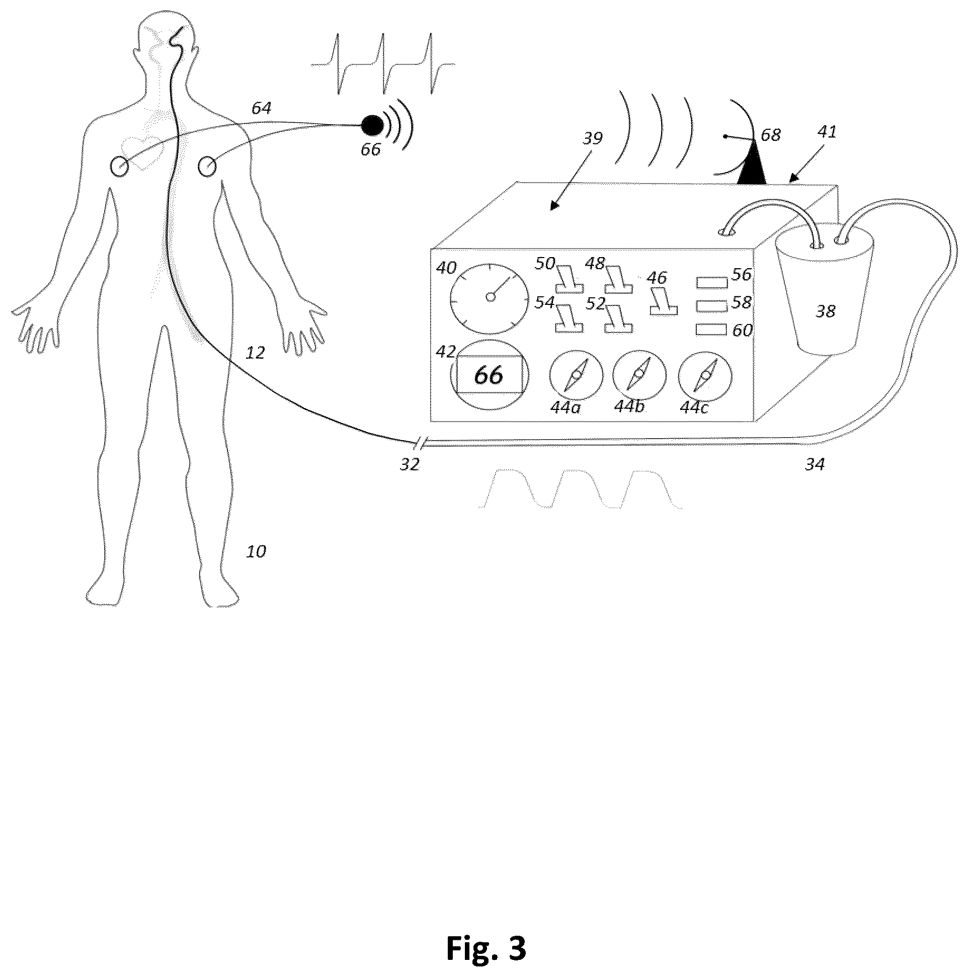 Patent US12496075 Figure 3 – Heart rate synchronous aspiration system and method for treatment of ischemic stroke