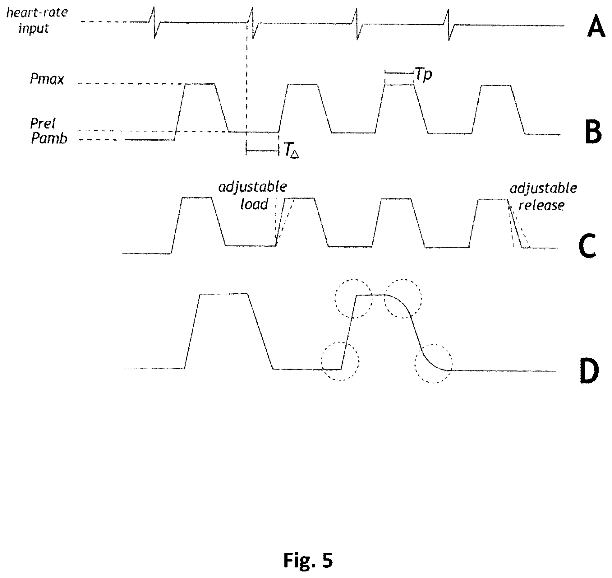 Patent US12496075 Figure 5 – Heart rate synchronous aspiration system and method for treatment of ischemic stroke