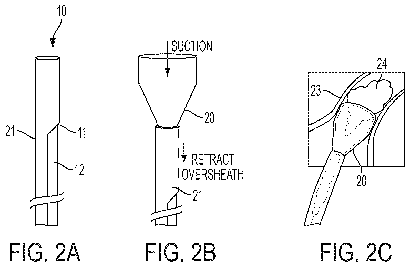 Patent US12496077 Figure 2 – Systems and methods for removing undesirable material within a circulatory system