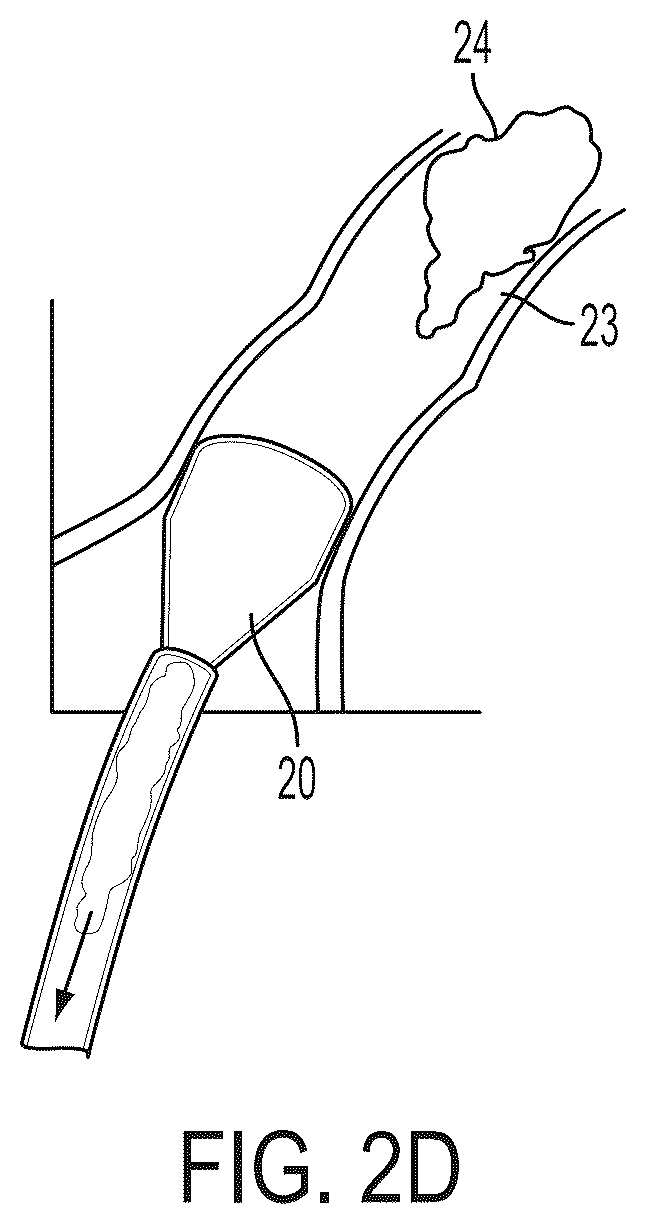 Patent US12496077 Figure 3 – Systems and methods for removing undesirable material within a circulatory system