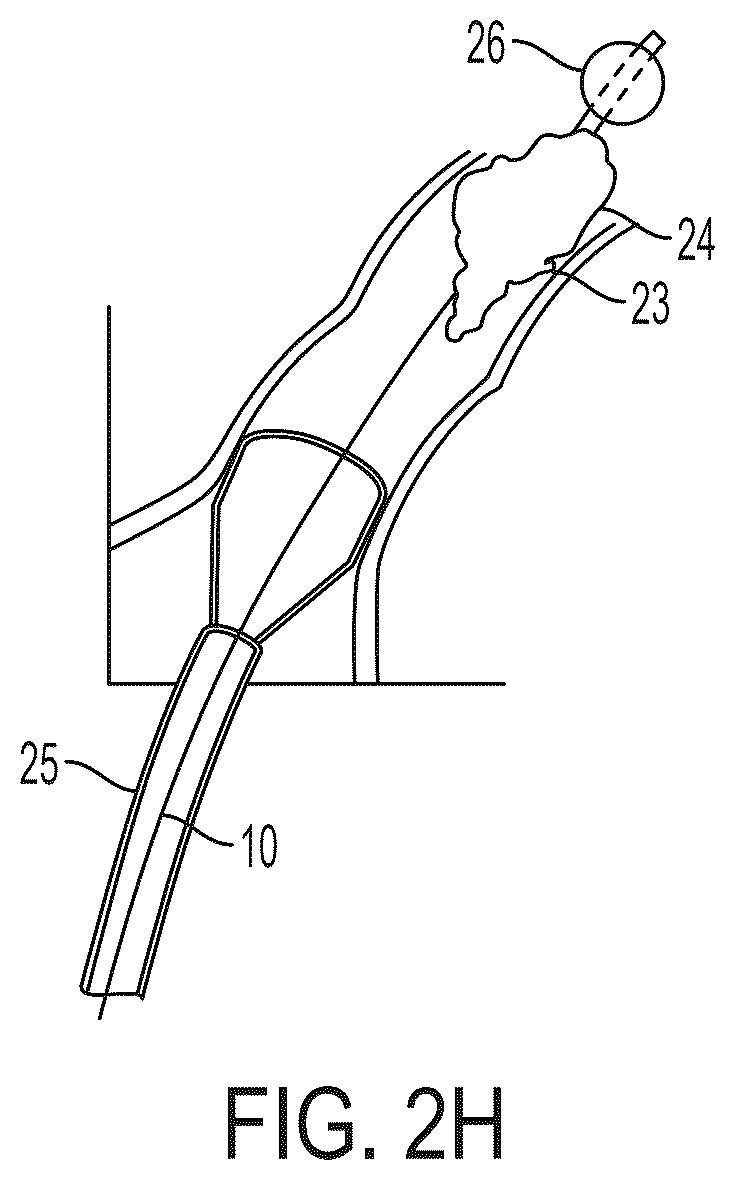Patent US12496077 Figure 5 – Systems and methods for removing undesirable material within a circulatory system