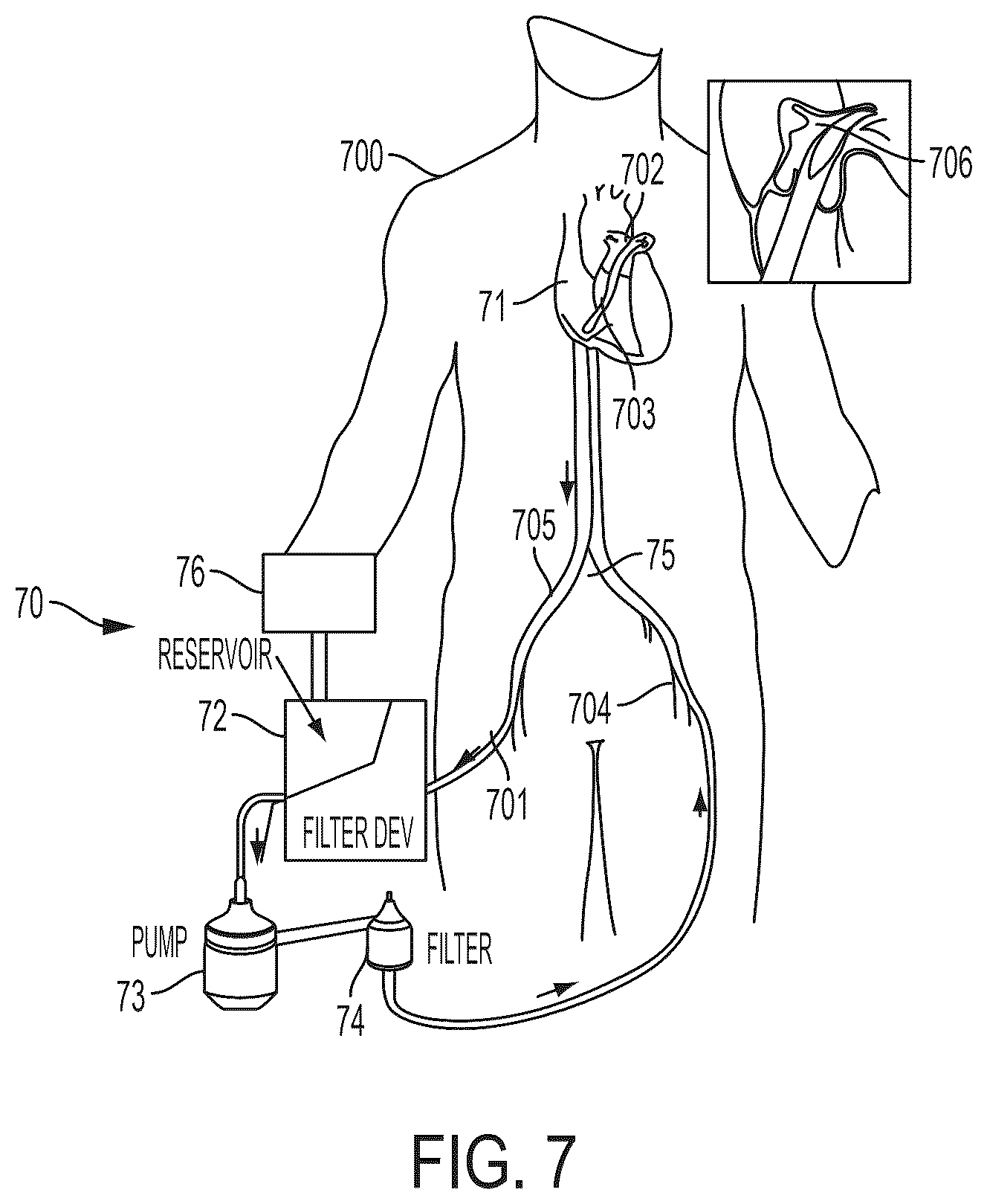 Patent US12496077 Figure 11 – Systems and methods for removing undesirable material within a circulatory system