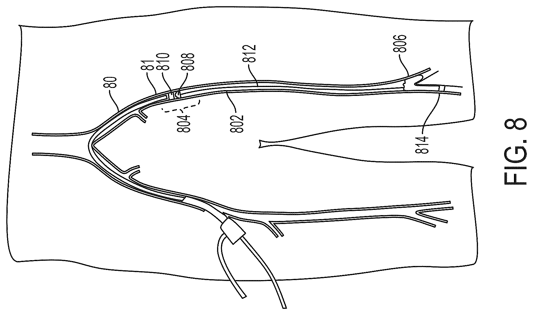 Patent US12496077 Figure 12 – Systems and methods for removing undesirable material within a circulatory system
