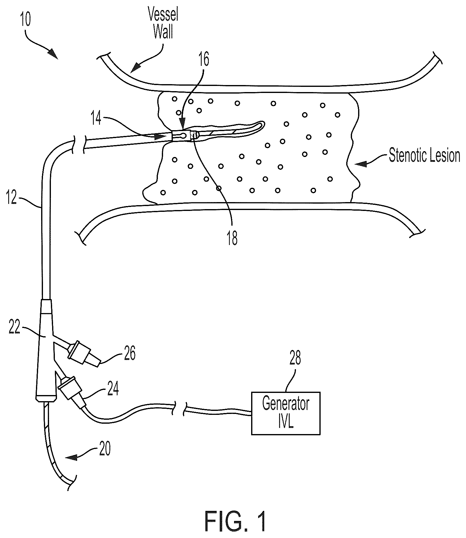 Patent US12496078 Figure 1 – Lithotripsy catheters having electrodes formed in metallization layers